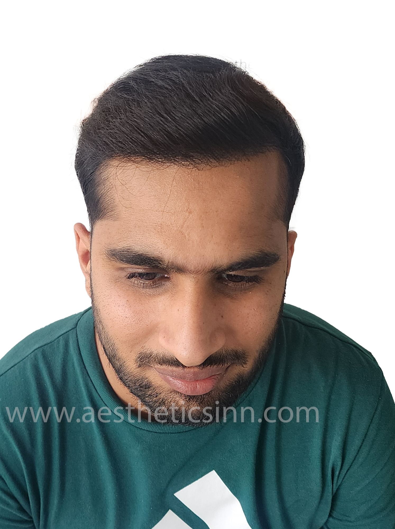 After Hair Restoration - Abuzar Abid