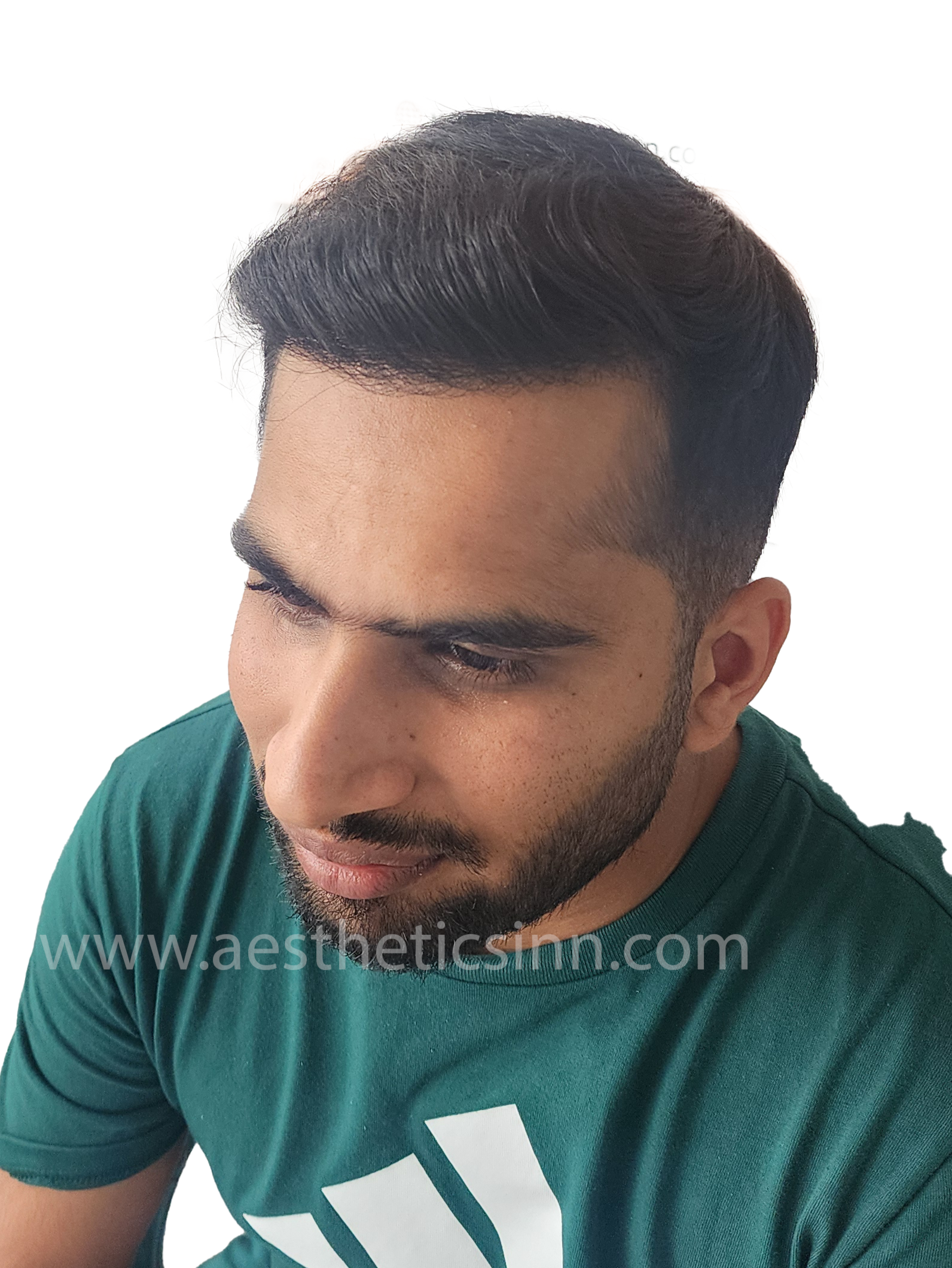 Abuzar Abid Left Temporal Angle After