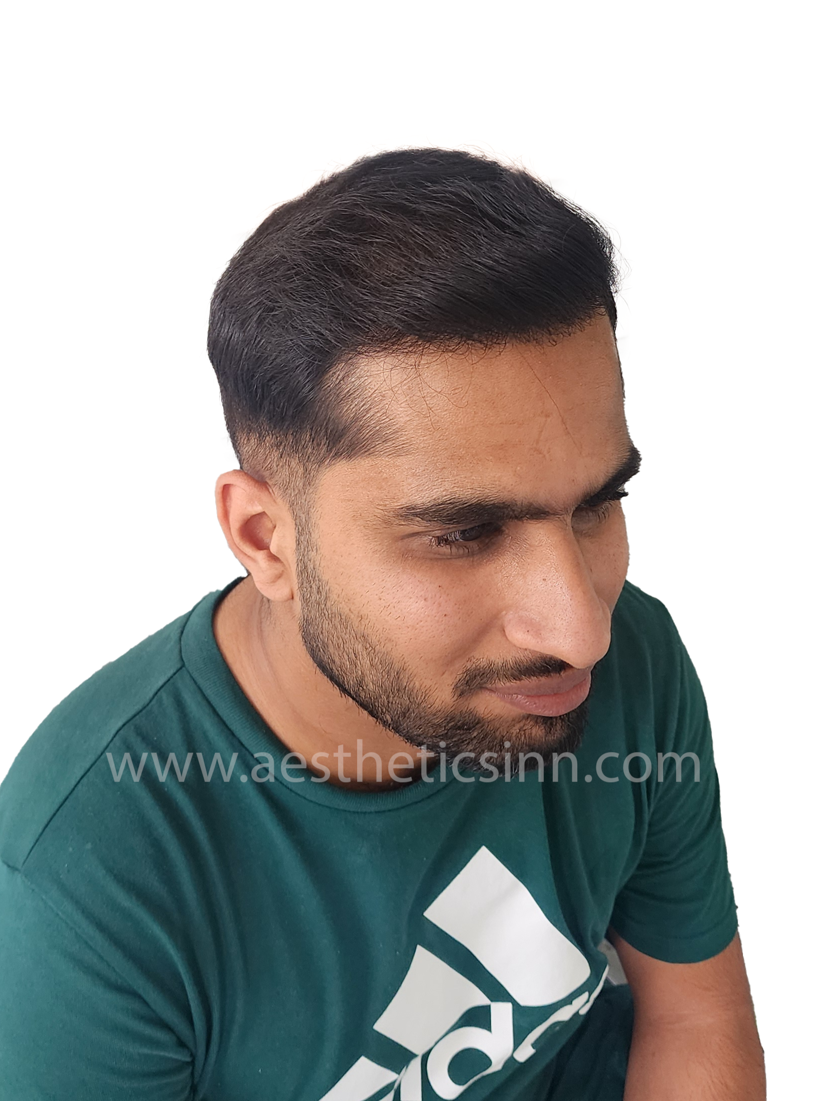 Abuzar Abid Right Oblique View After