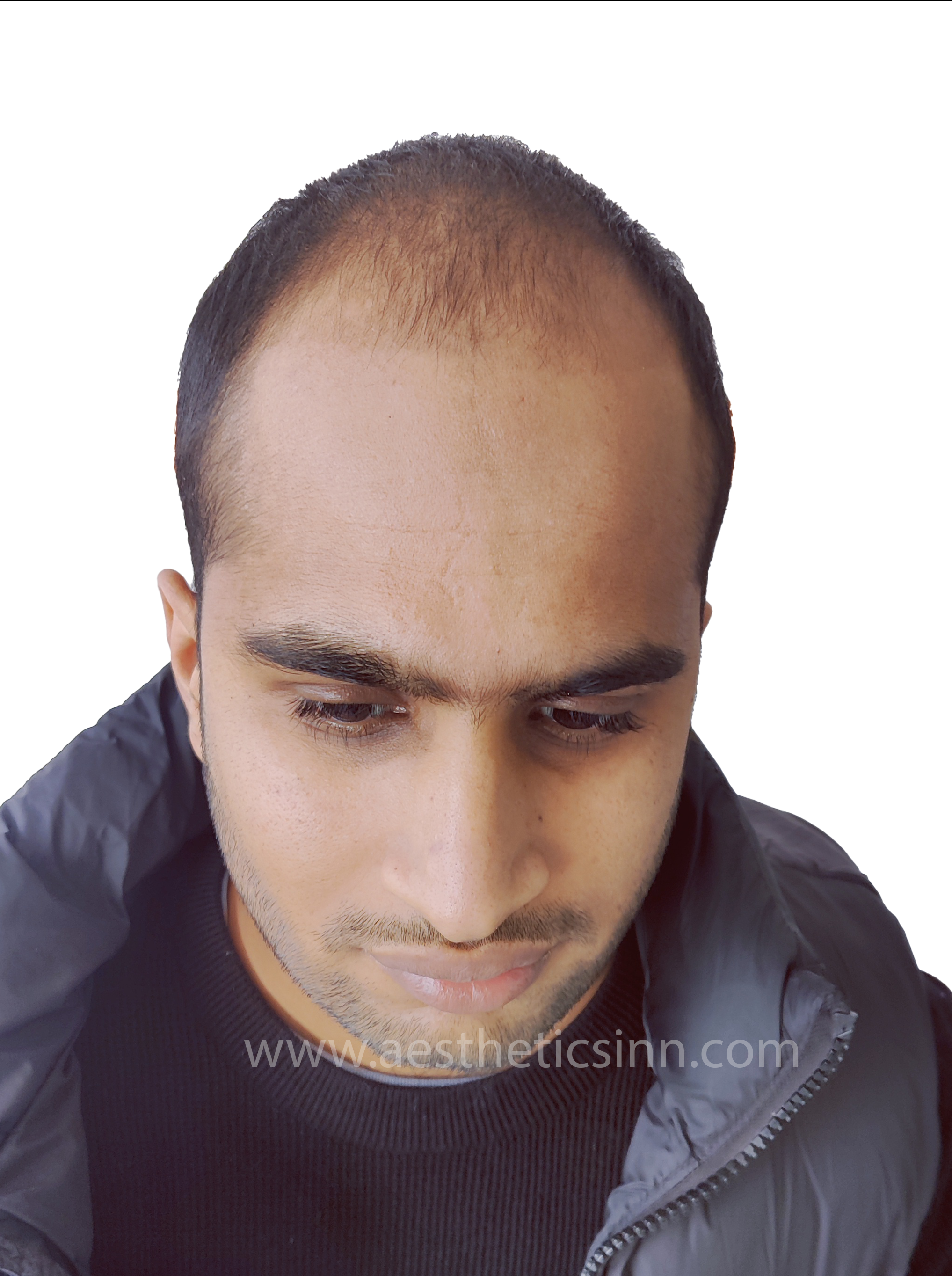 Before Hair Restoration - Abuzar Abid