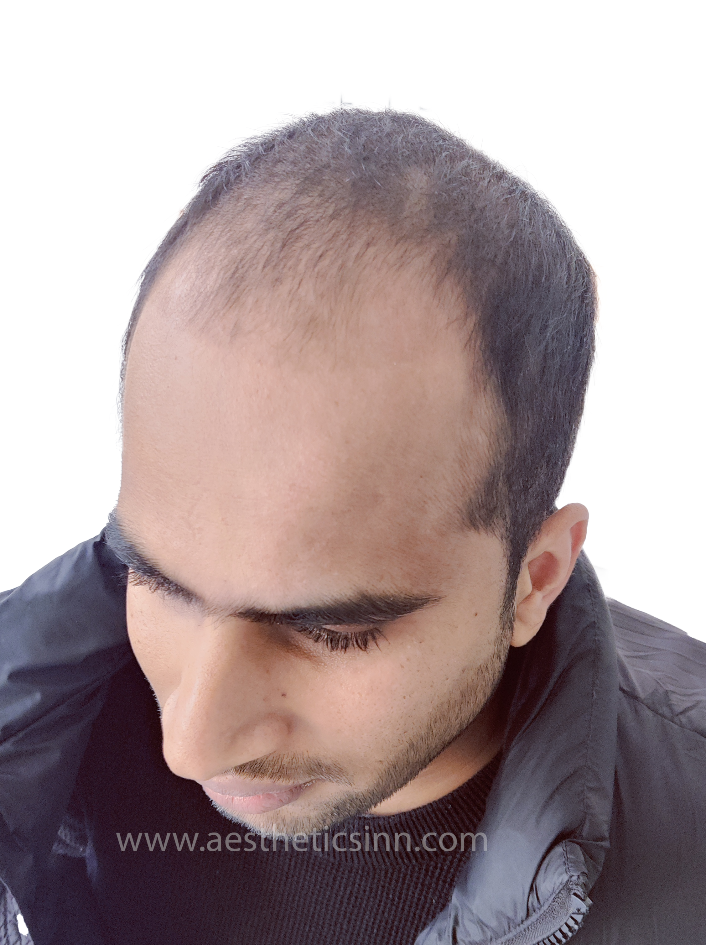Abuzar Abid Left Temporal Angle Before
