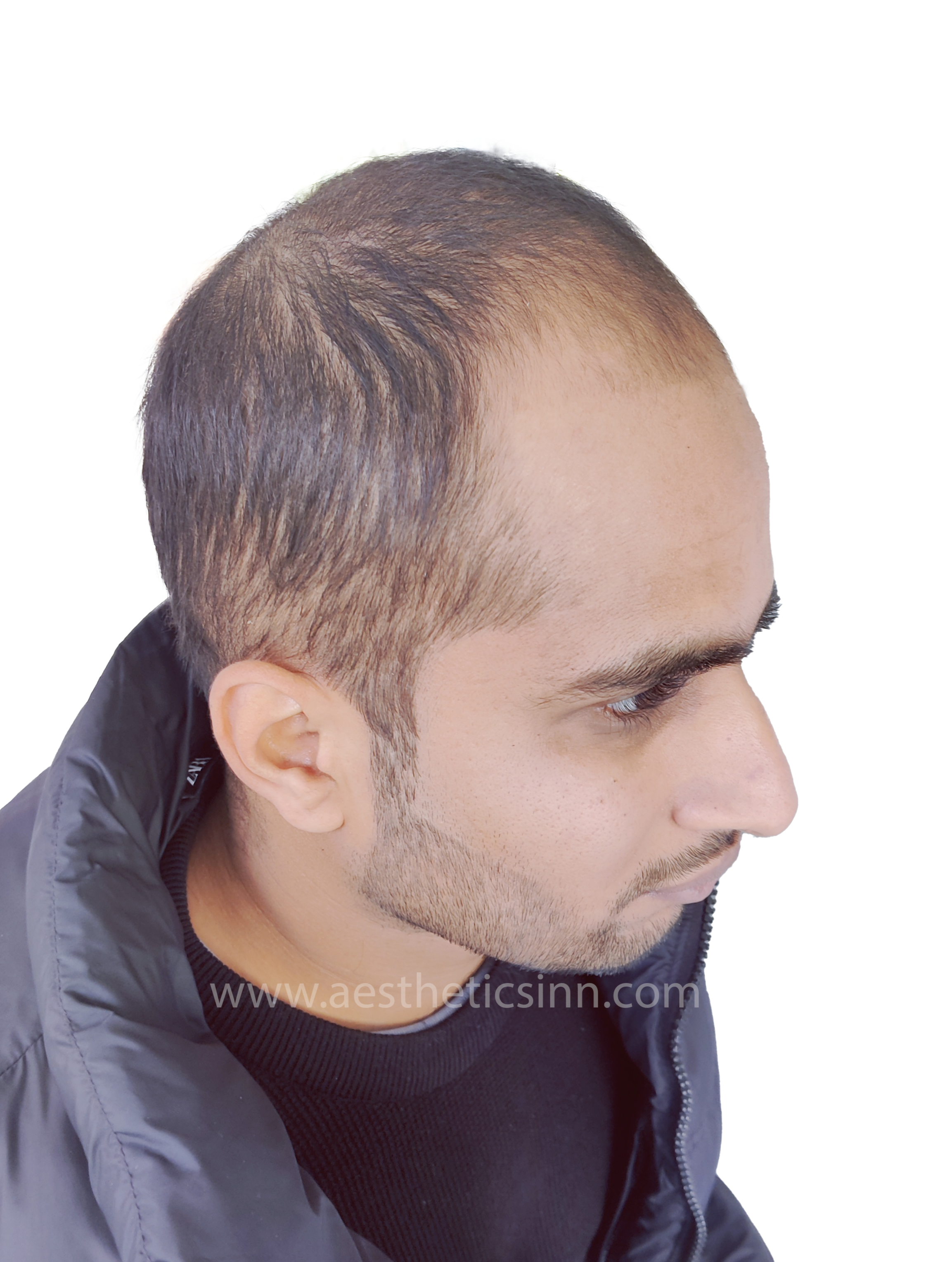Abuzar Abid Right Oblique View Before