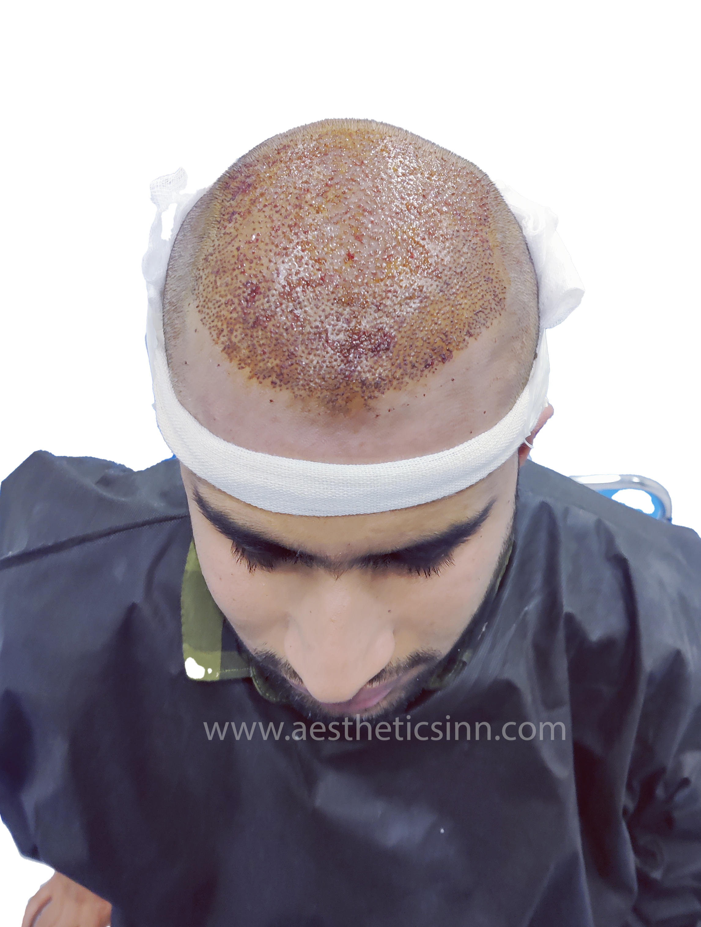 Abuzar Abid Post-Op Implantation