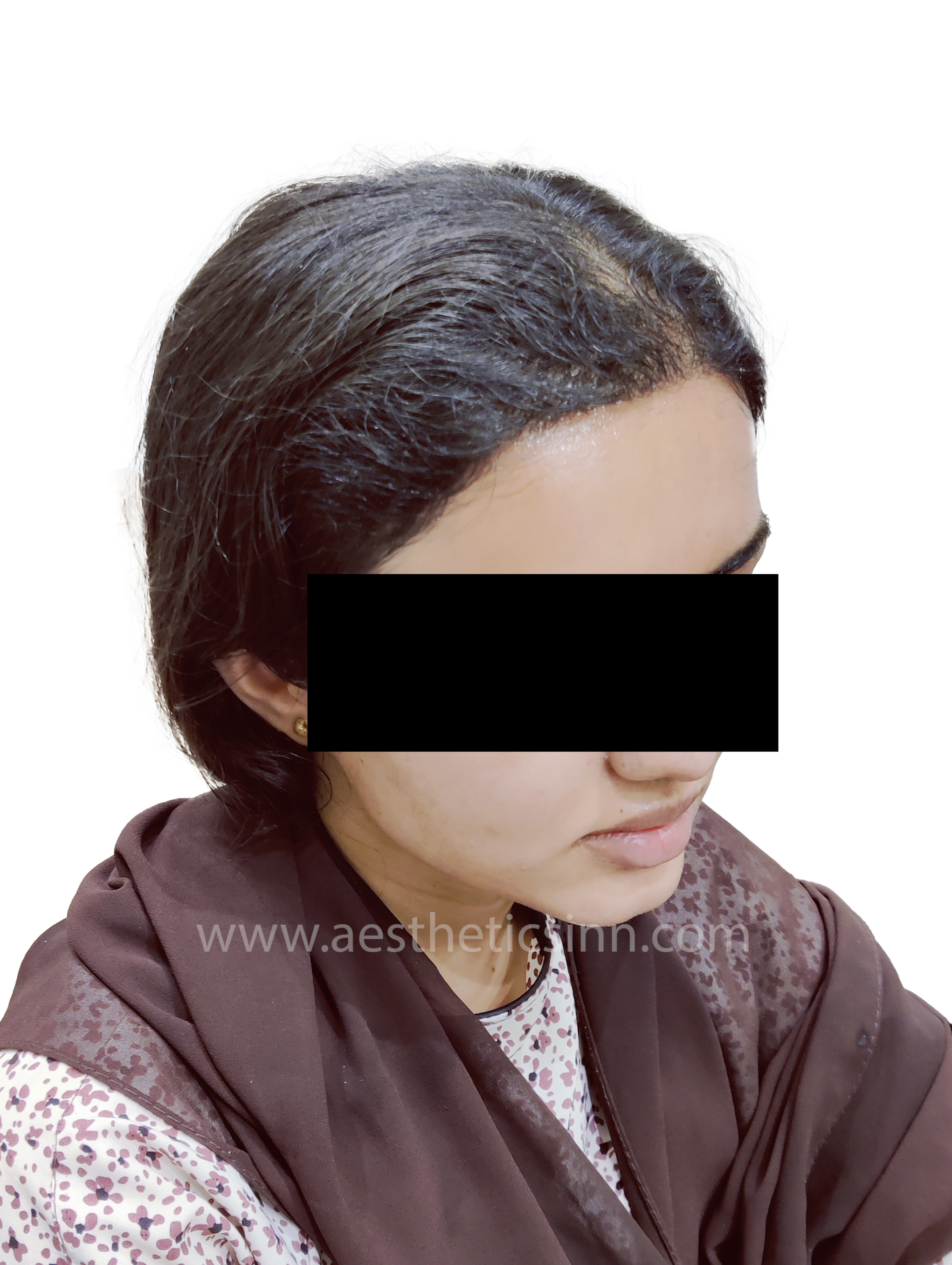 Aqsa Hameed Lateral Profile After
