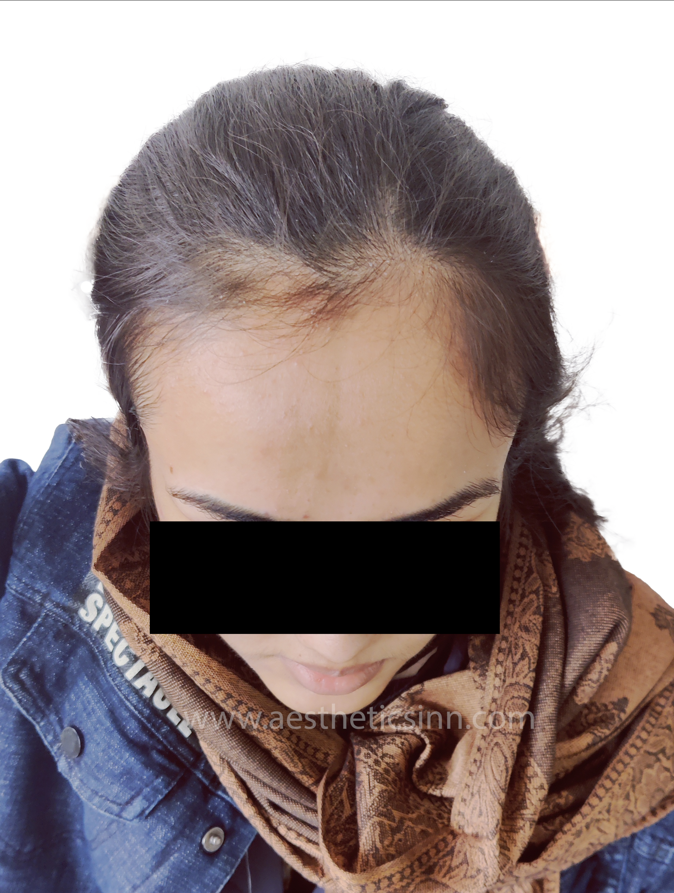 Before Female Hairline Lowering - Aqsa Hameed