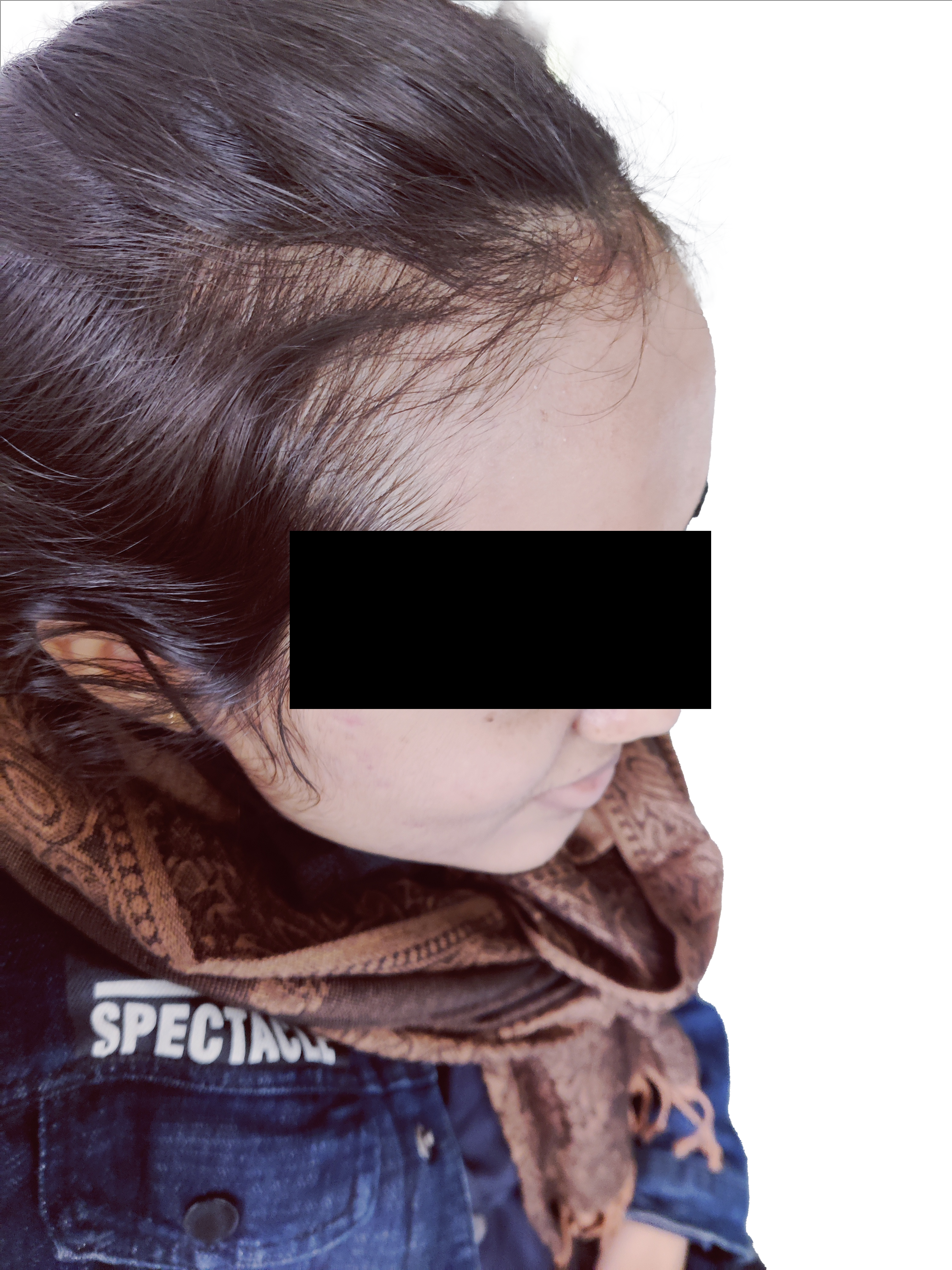 Aqsa Hameed Lateral Profile Before