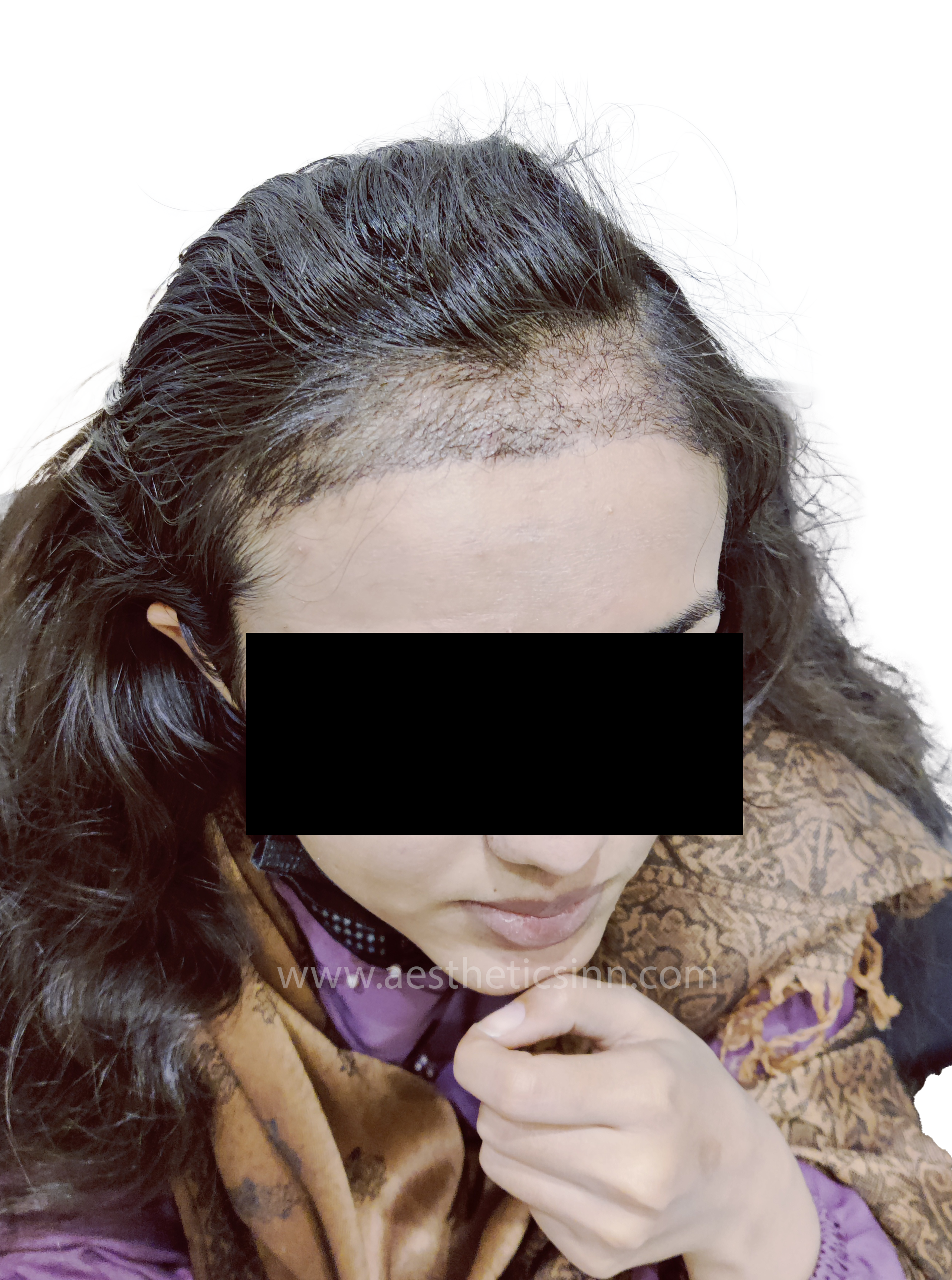 Aqsa Hameed Immediate Post-Op Implantation