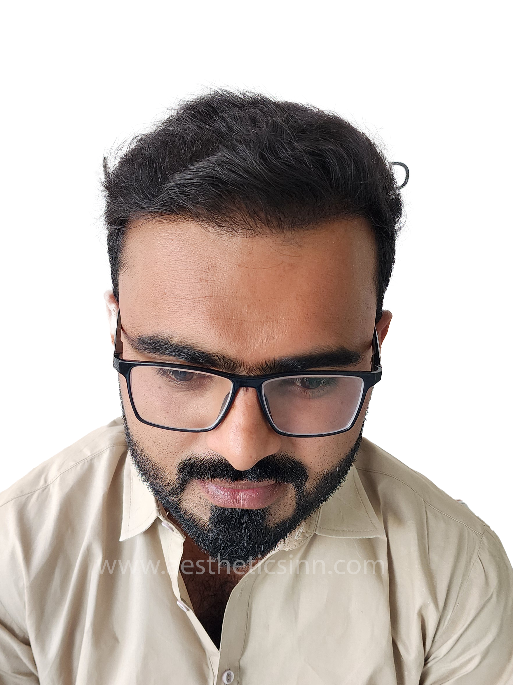After Hair Transplant - Azfar Javed
