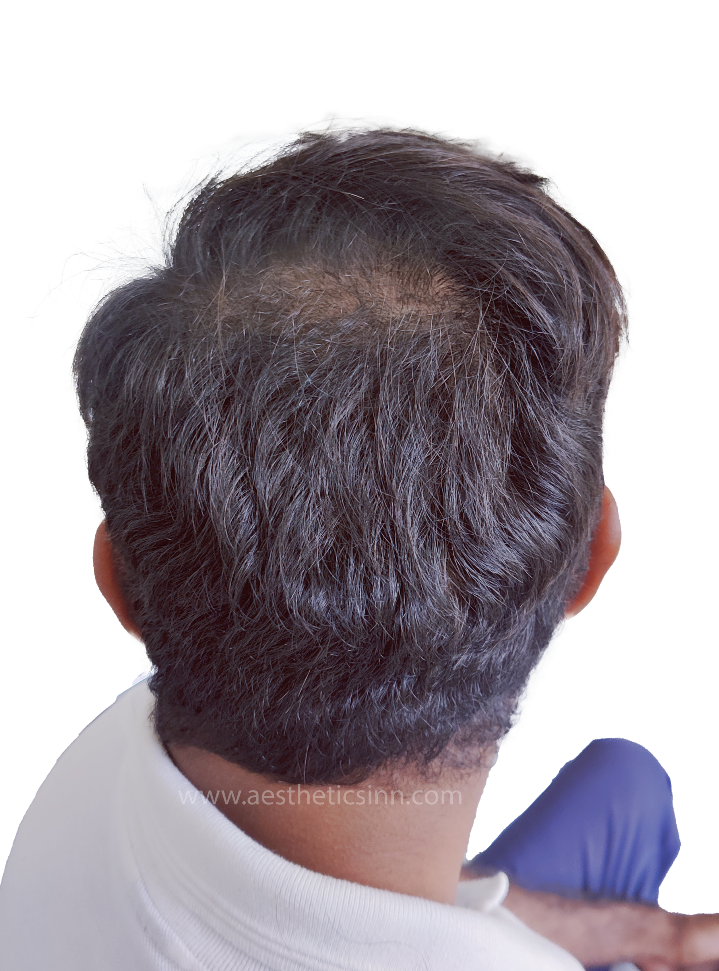 Before Hair Transplant - Azfar Javed