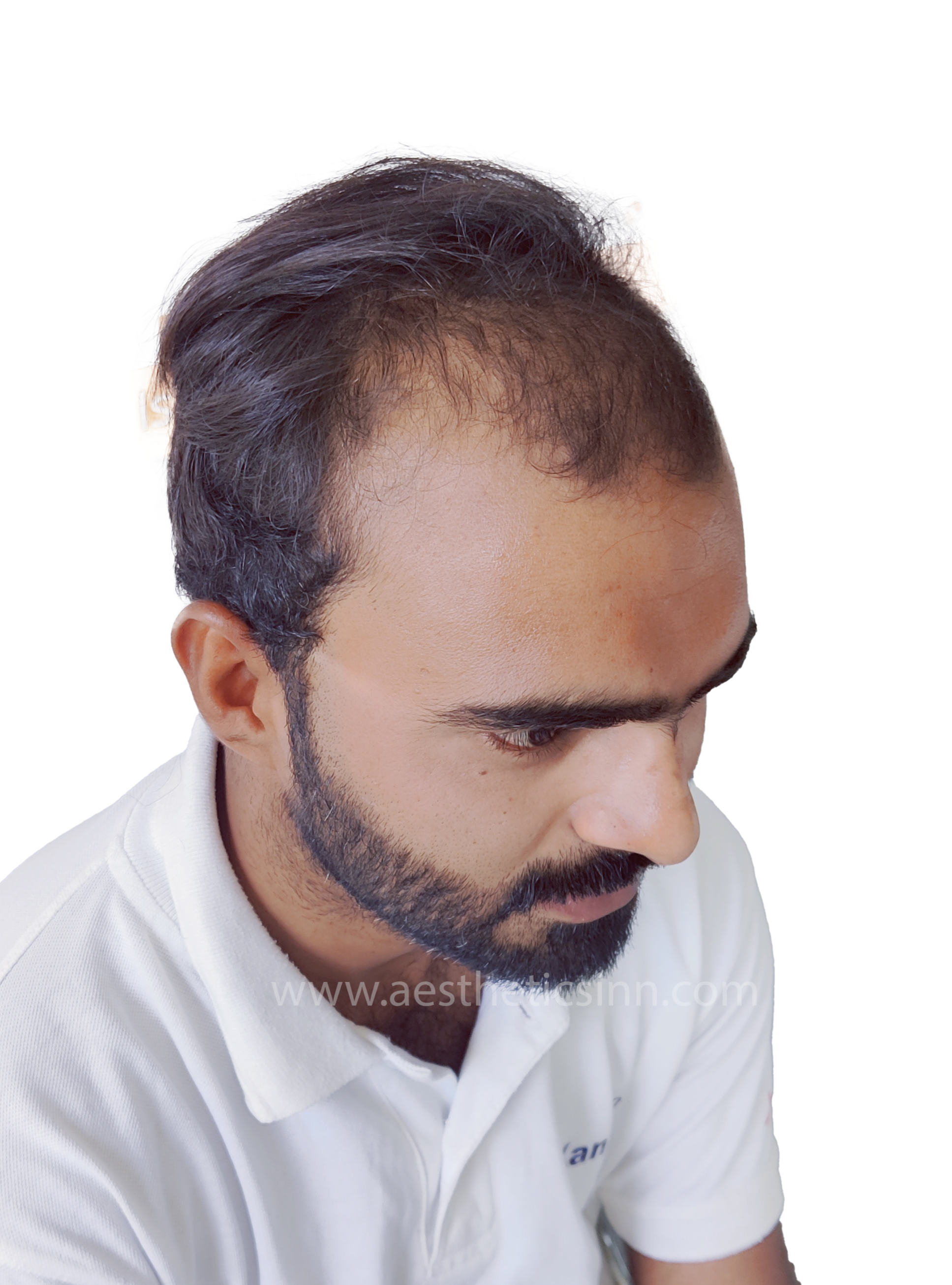 Azfar Javed Top View Before