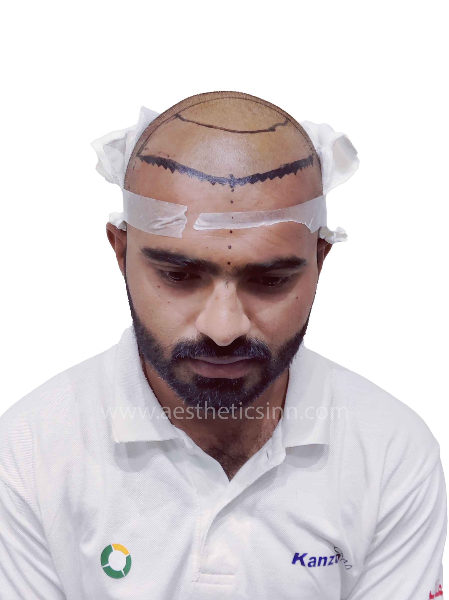 Azfar Javed Surgical Marking