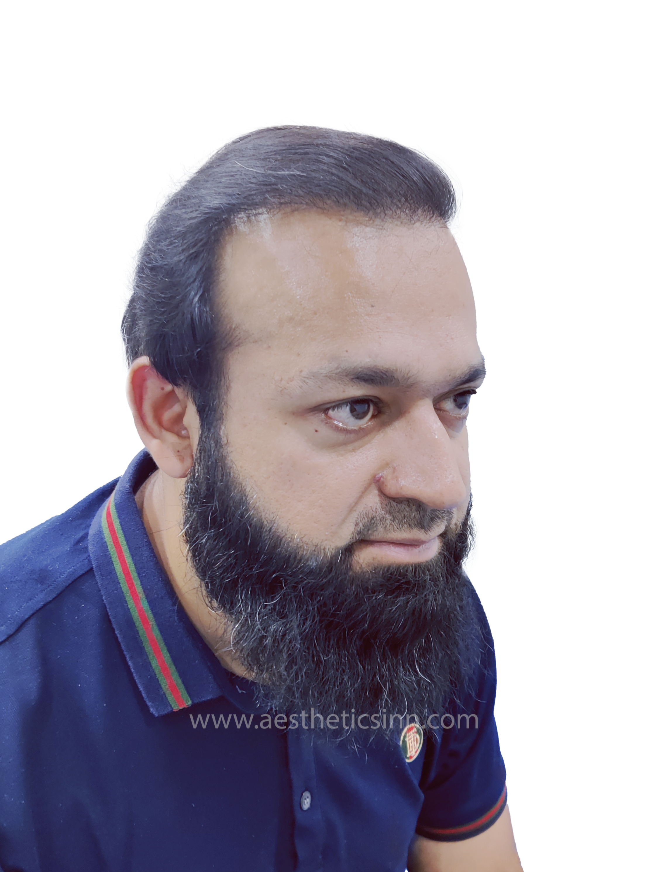Dr. Salman Right Temple After