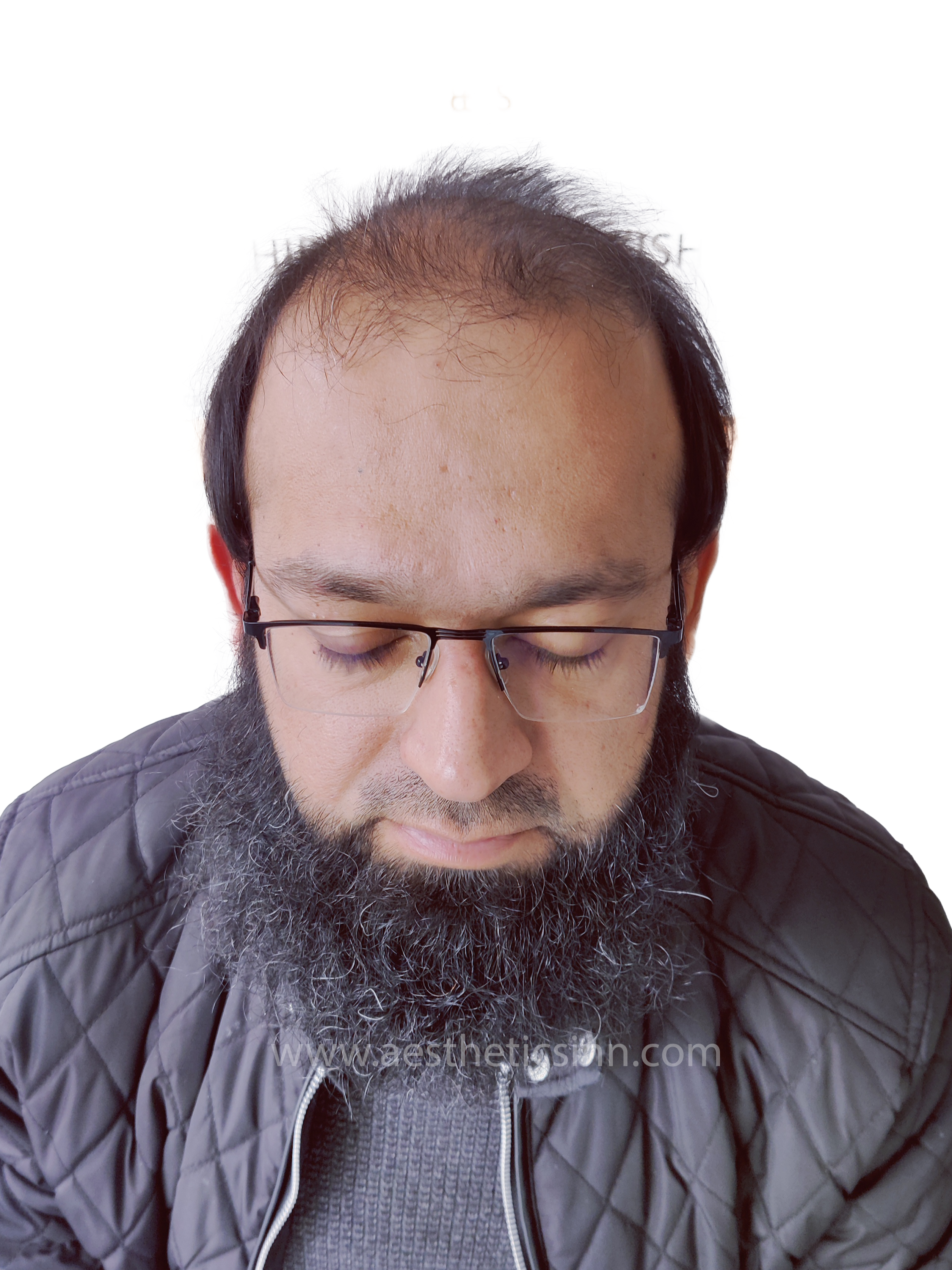 Before Hair Transplant - Dr. Salman
