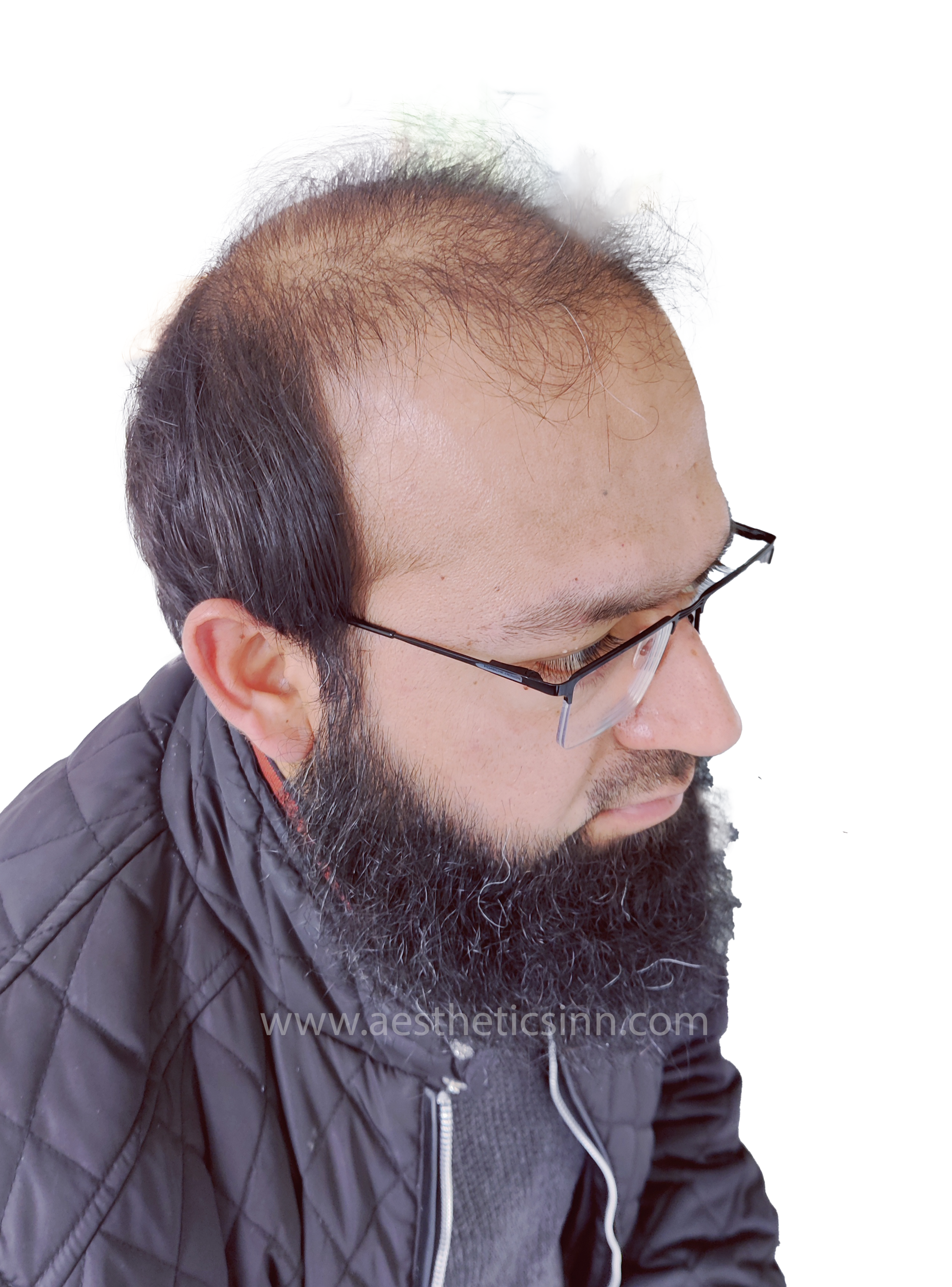 Dr. Salman Right Temple Before