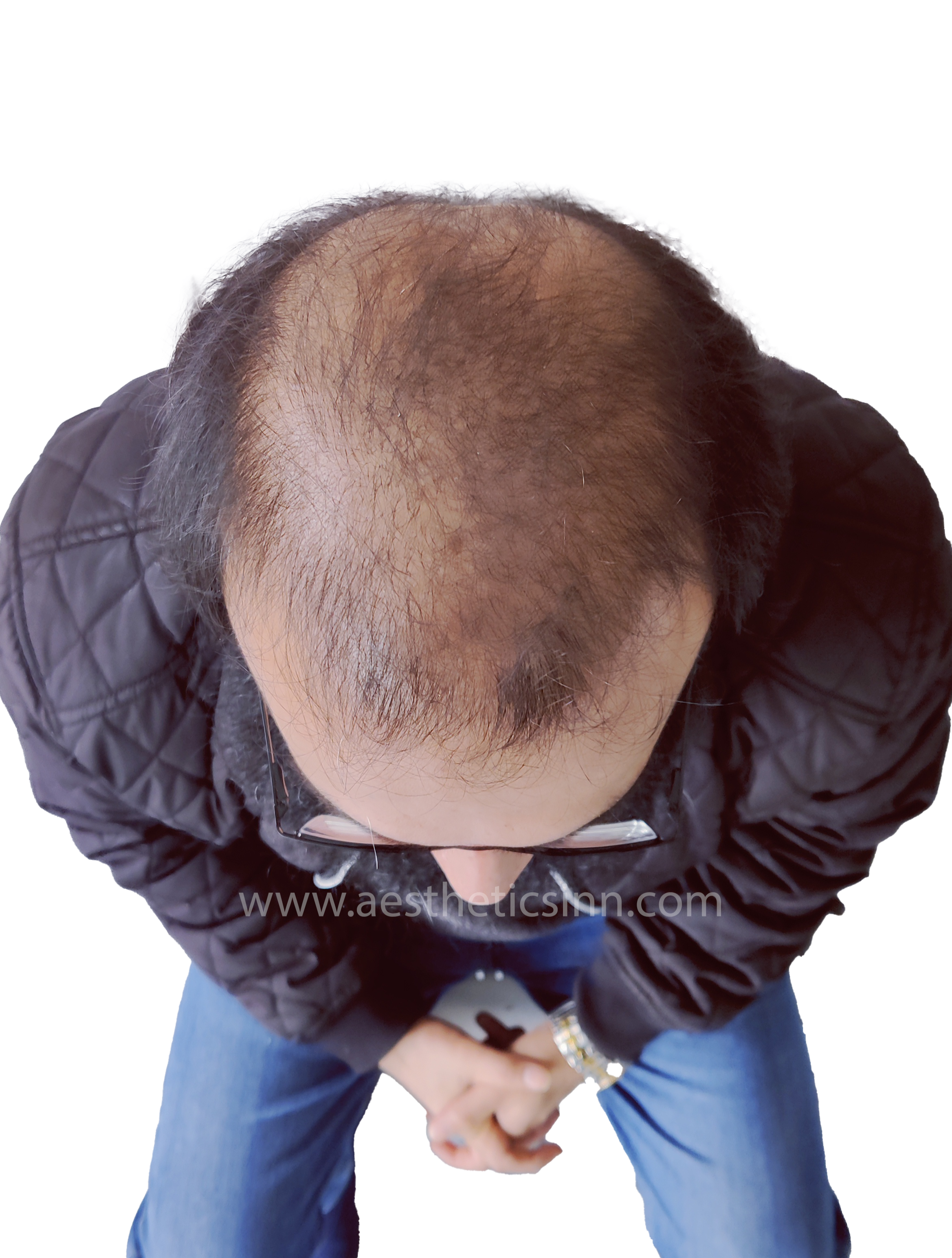 Dr. Salman Day 0 Grafting Profile
