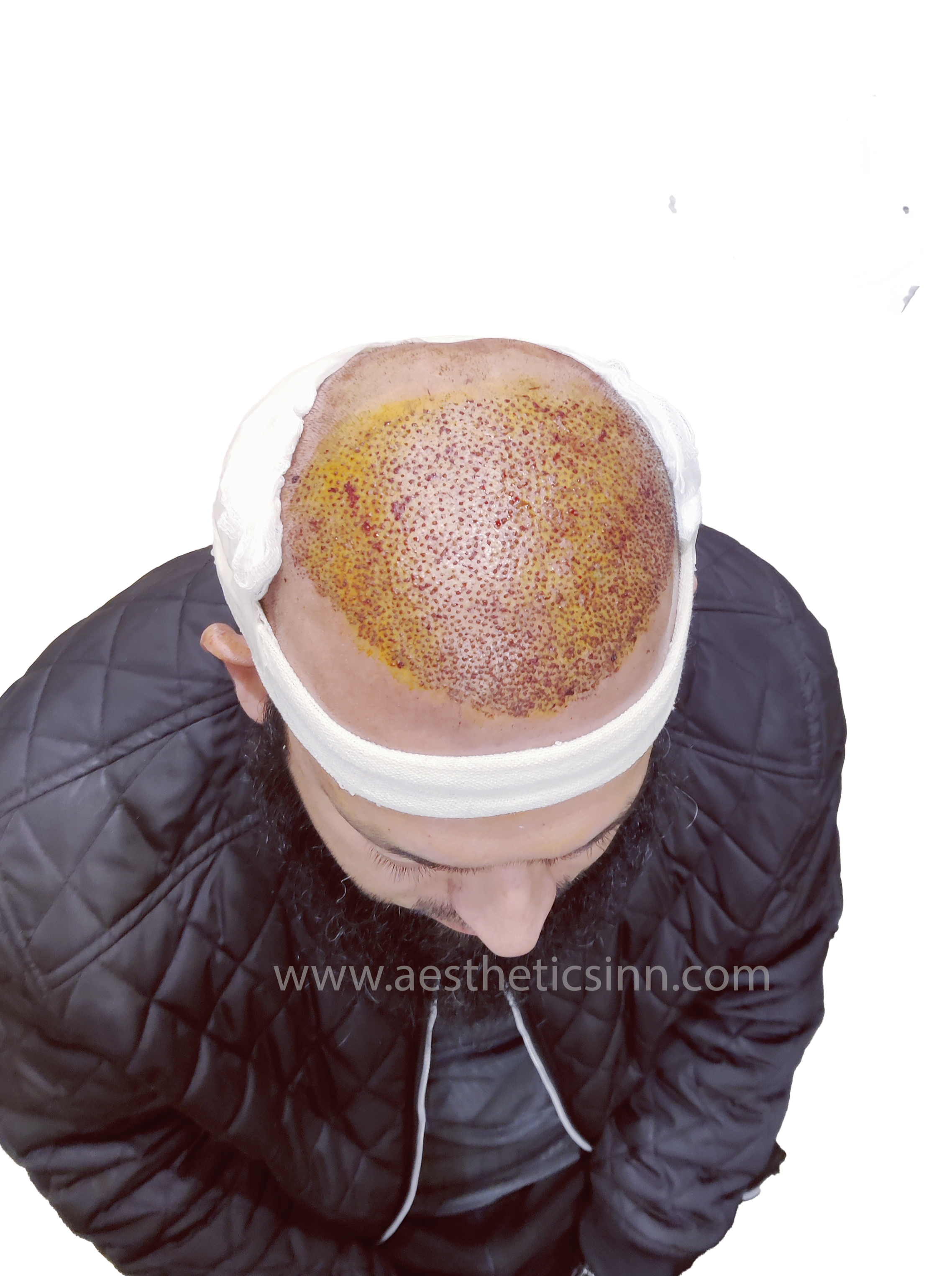 Dr. Salman Top View Immediate Post-Op