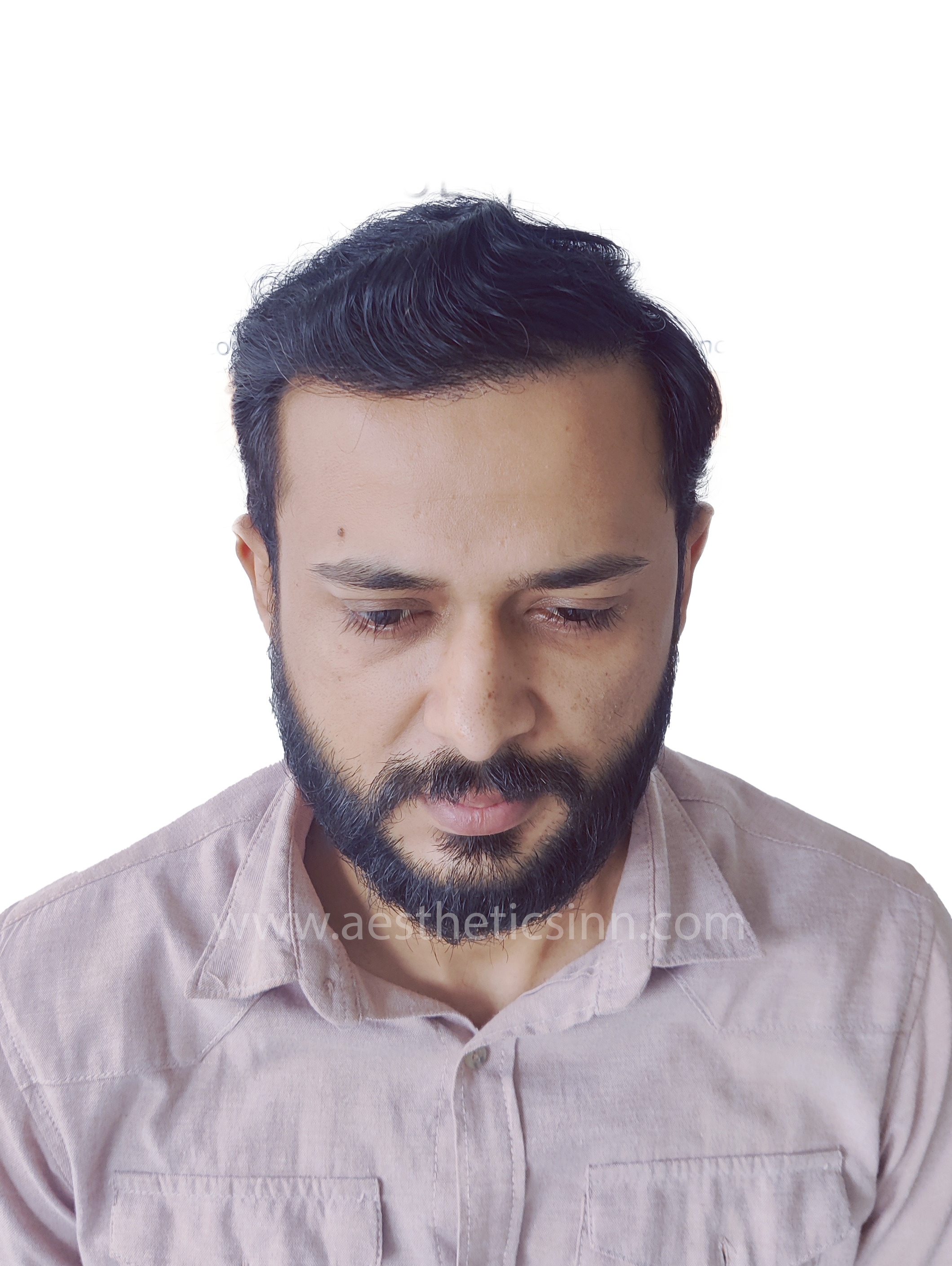 After Hair Transplant - Ibrar Shami