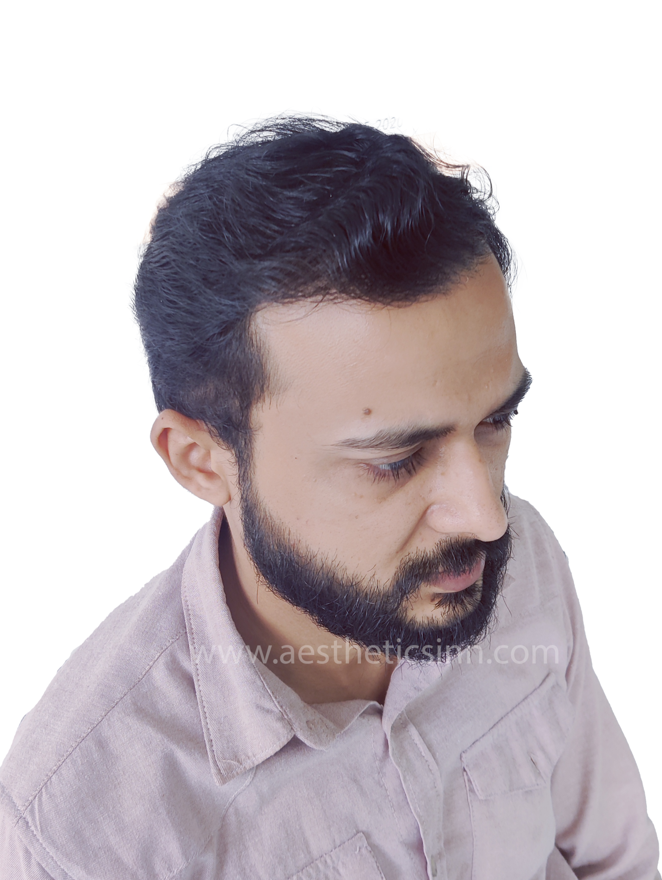 Ibrar Shami Left Profile After