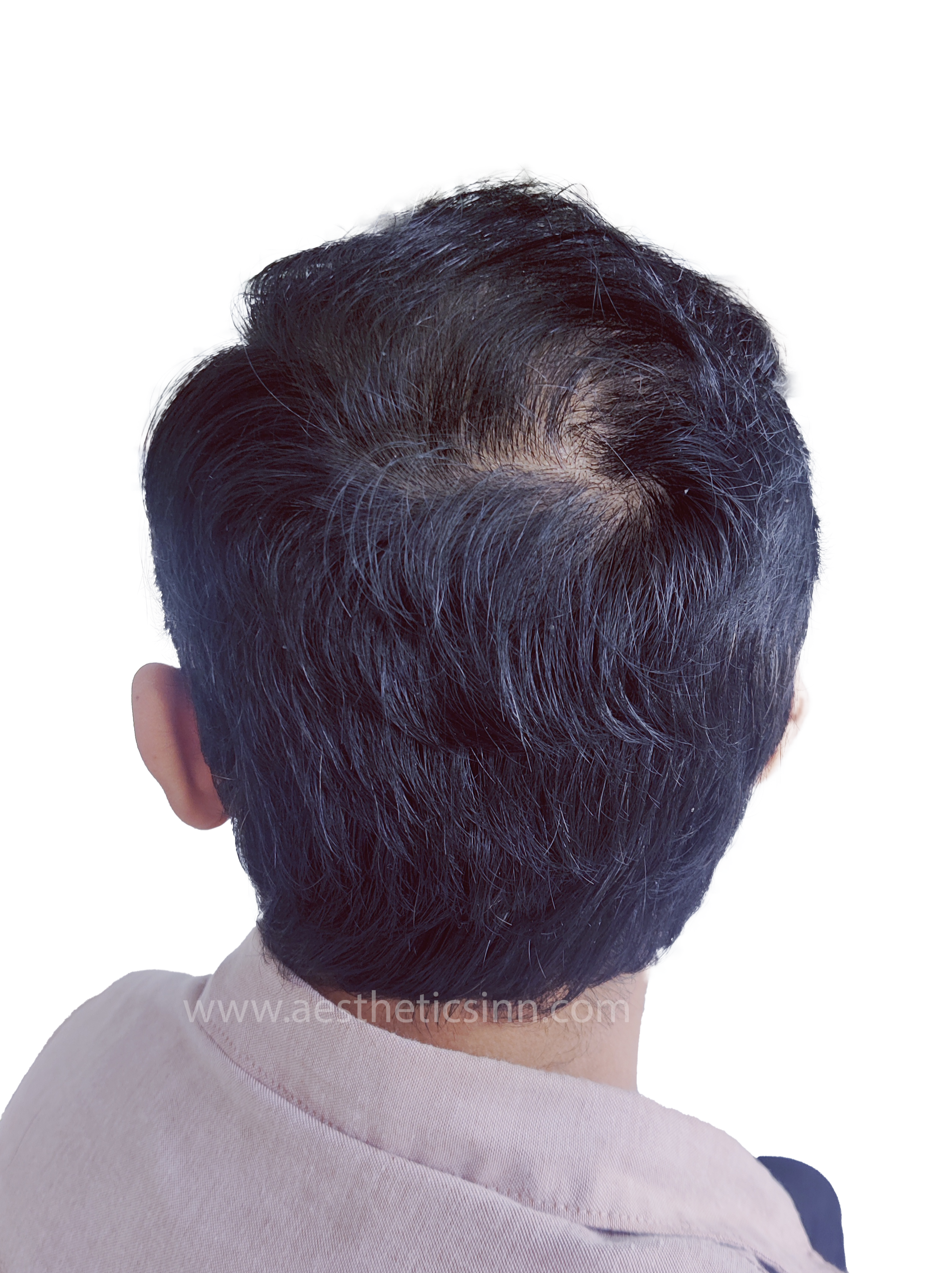Ibrar Shami Crown Vertex After