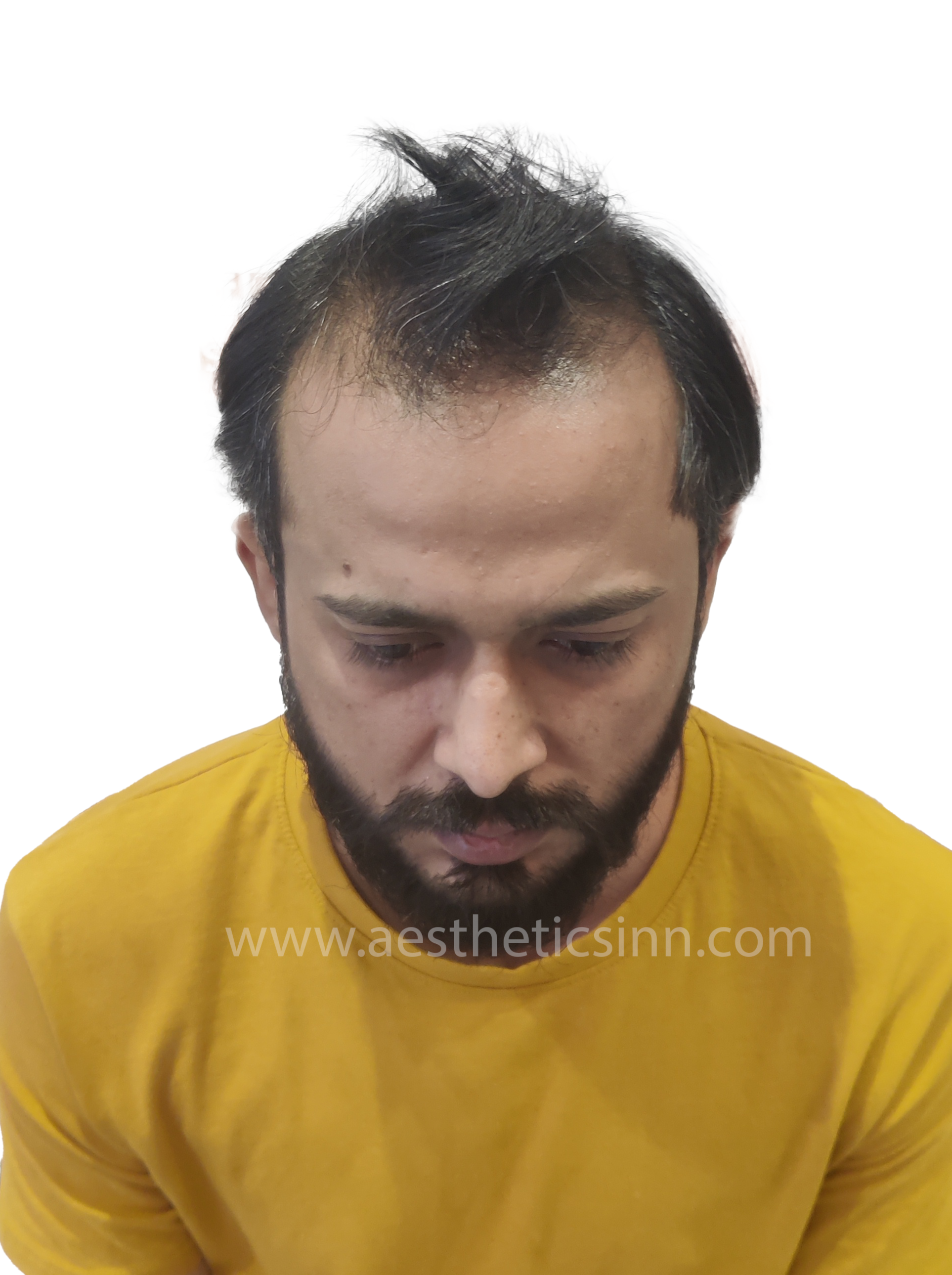 Before Hair Transplant - Ibrar Shami