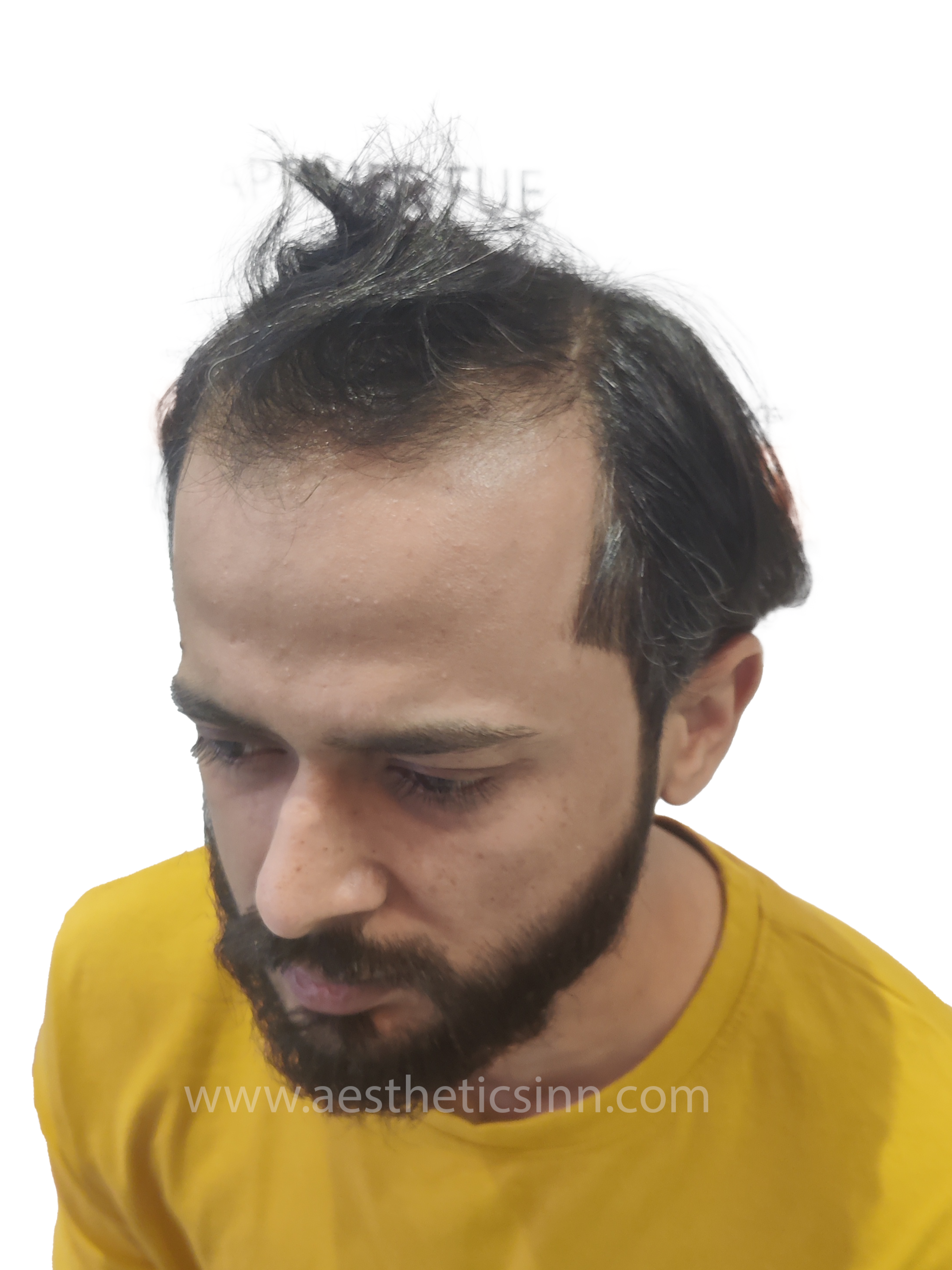Ibrar Shami Right Profile Before