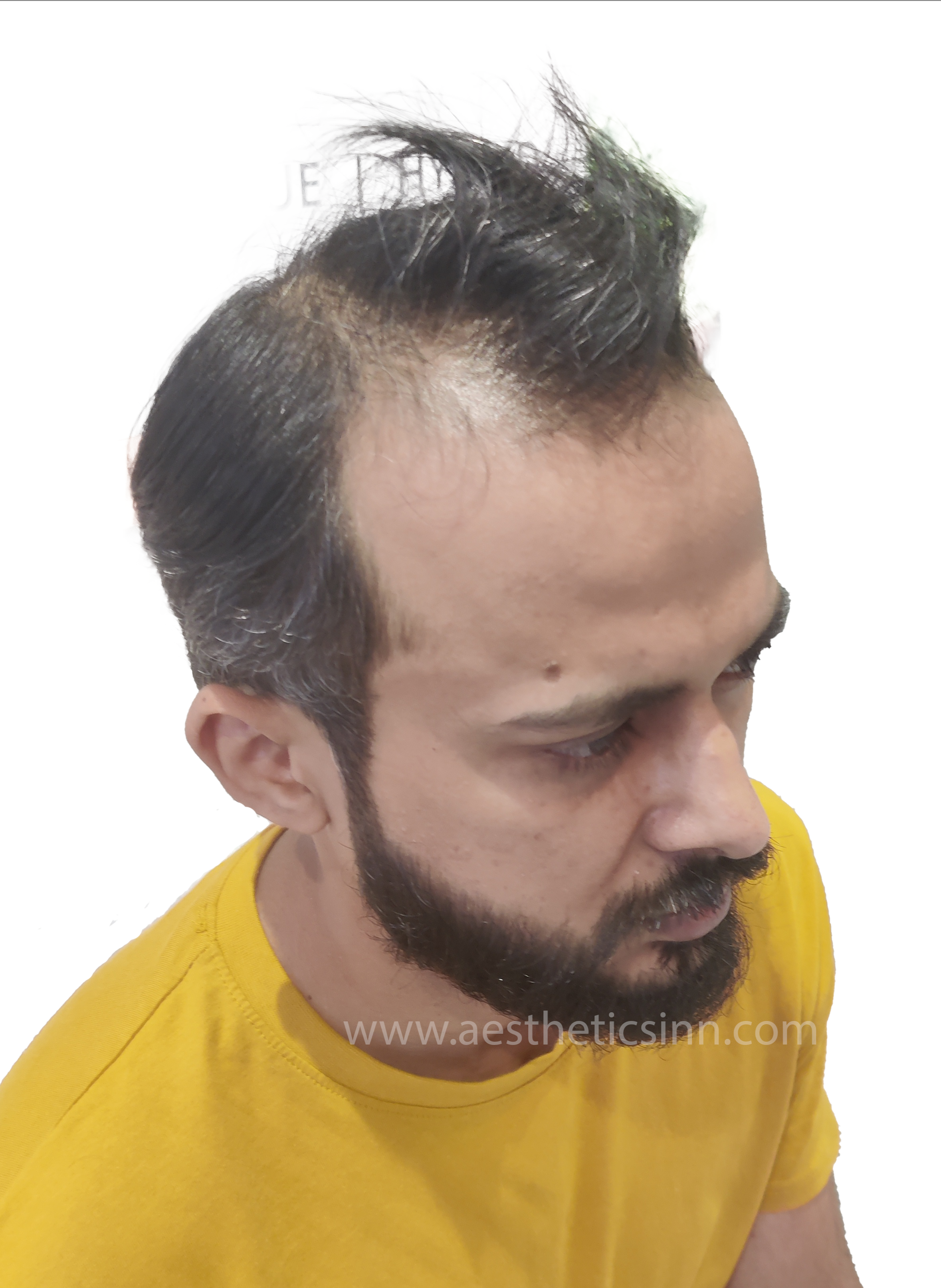 Ibrar Shami Left Profile Before