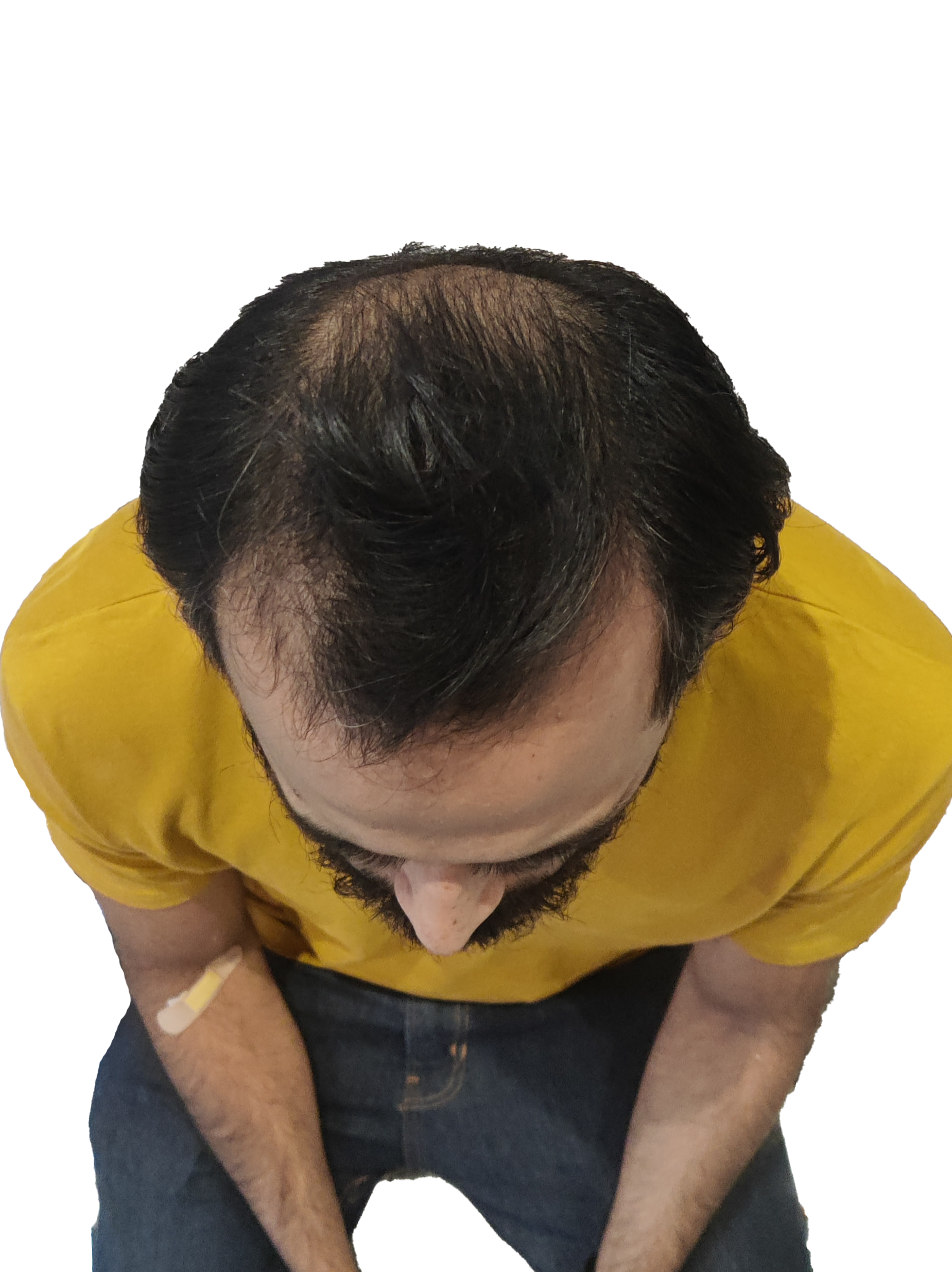 Ibrar Shami Mid-Scalp Before