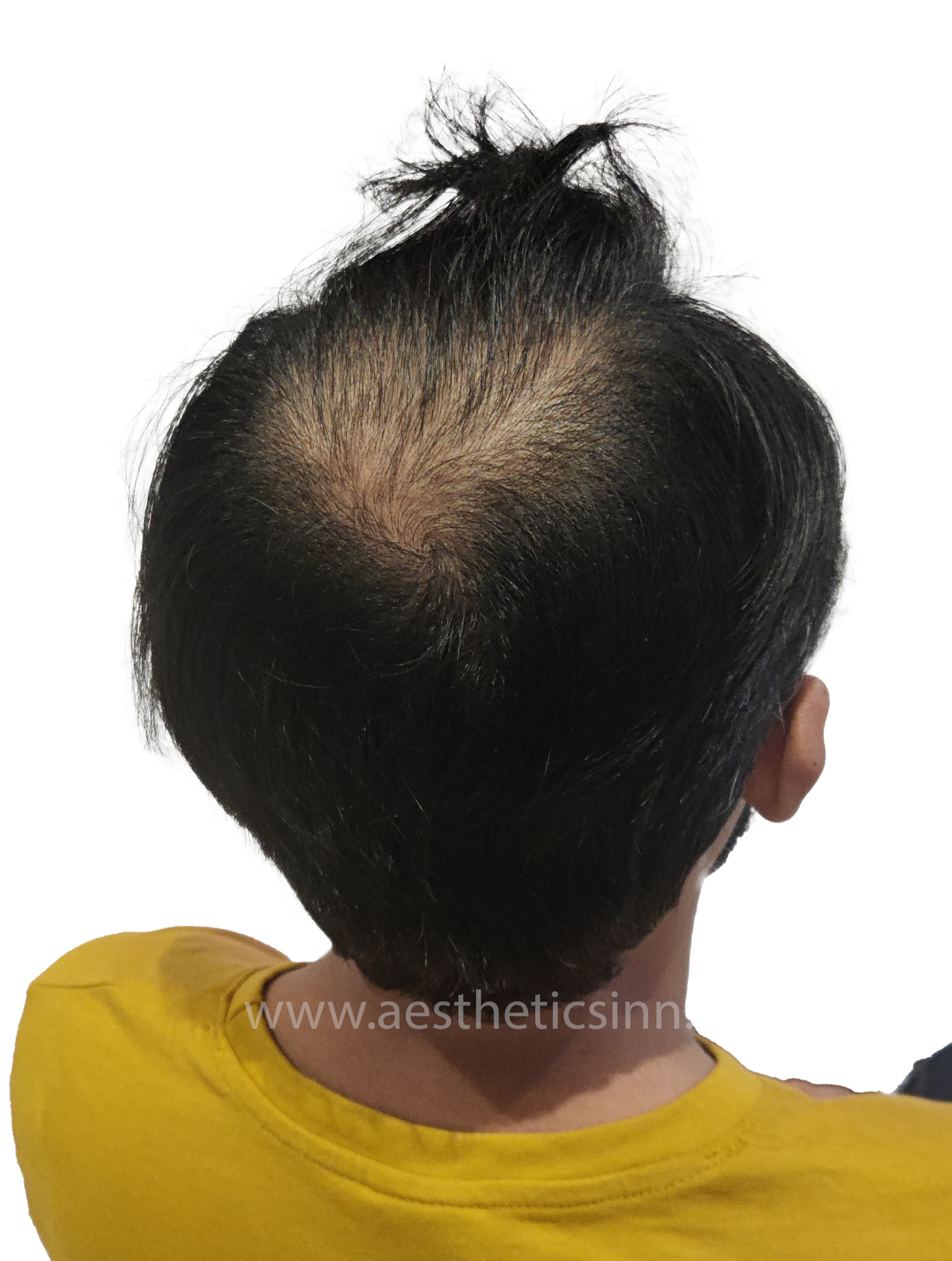 Ibrar Shami Crown Vertex Before