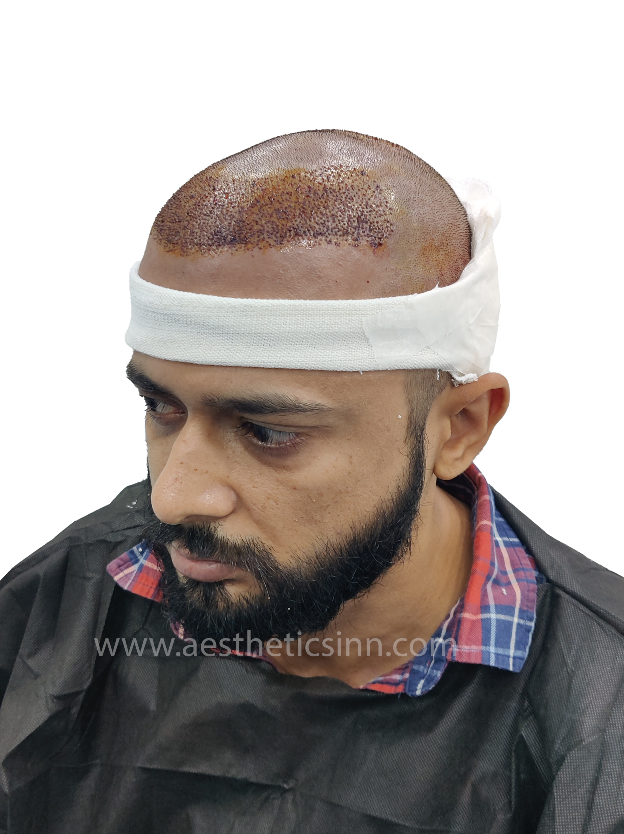 Ibrar Shami Pre-Op Hairline Design