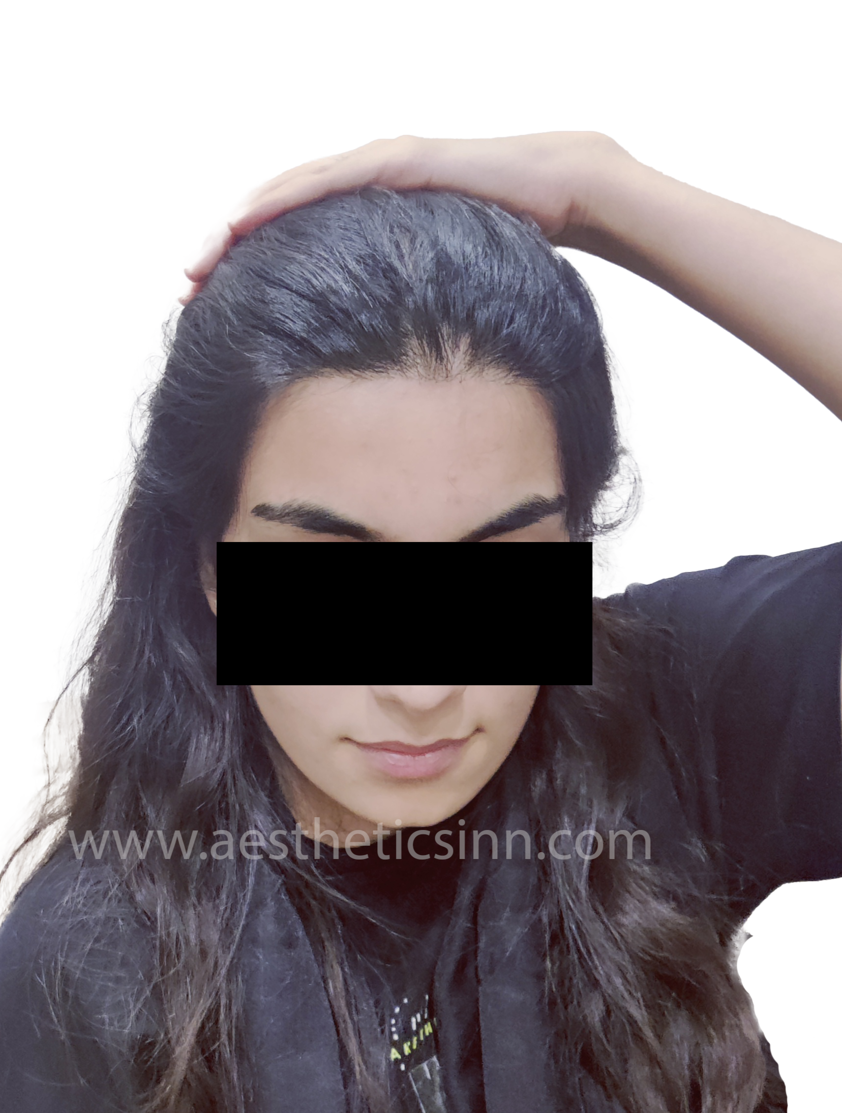 After Female Hairline Lowering - Muntaha