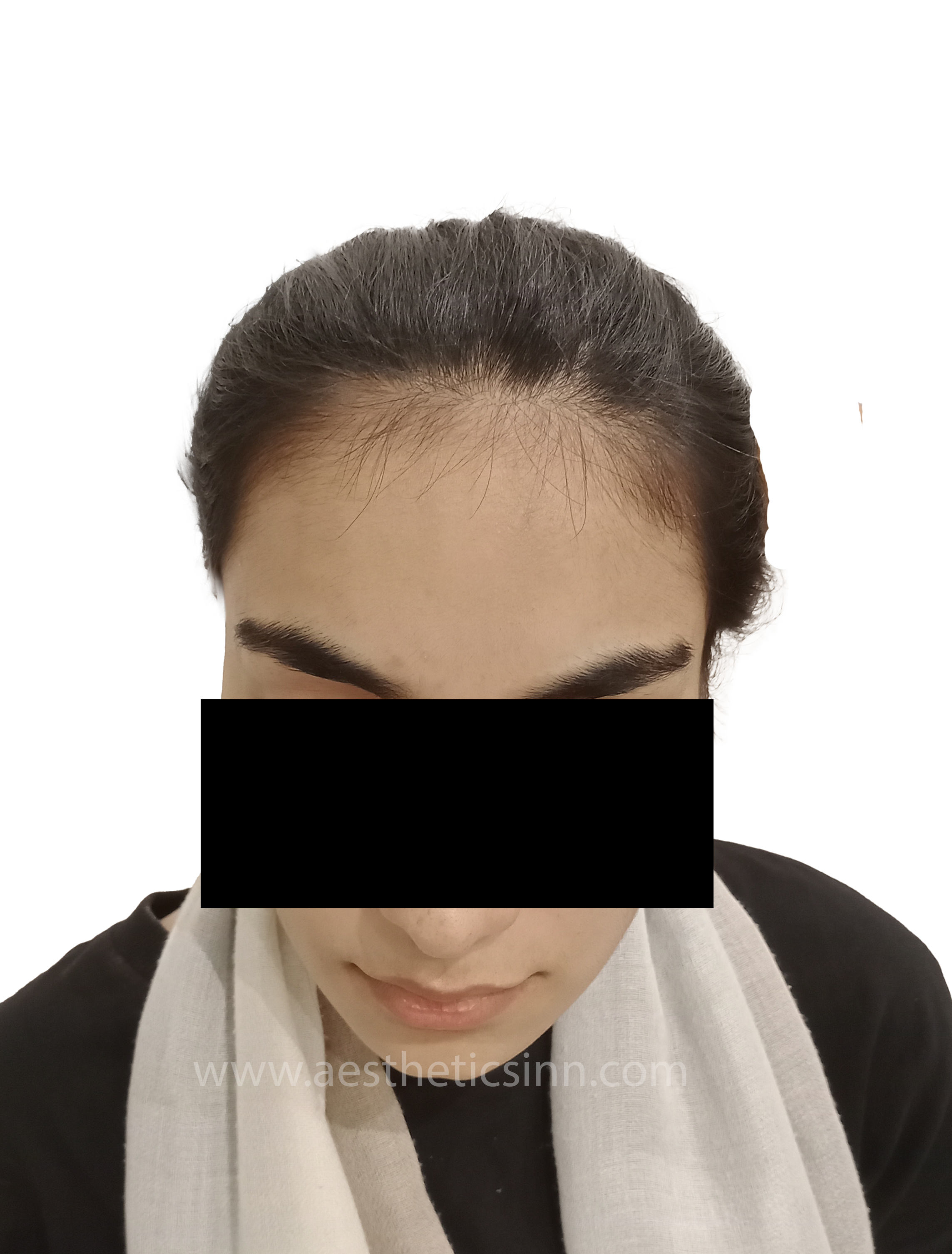 Before Female Hairline Lowering - Muntaha