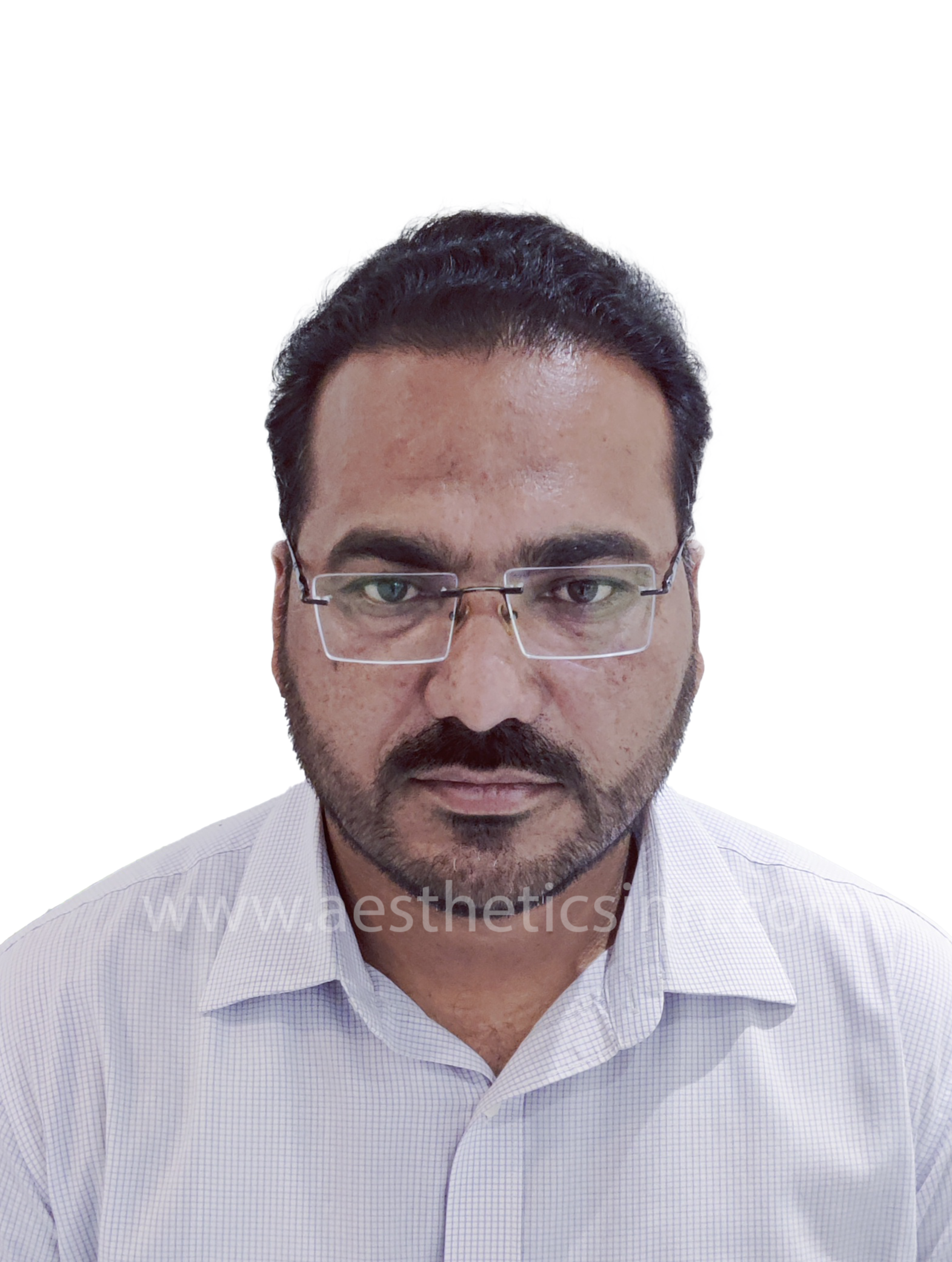 After Hair Transplant - Riaz Butt