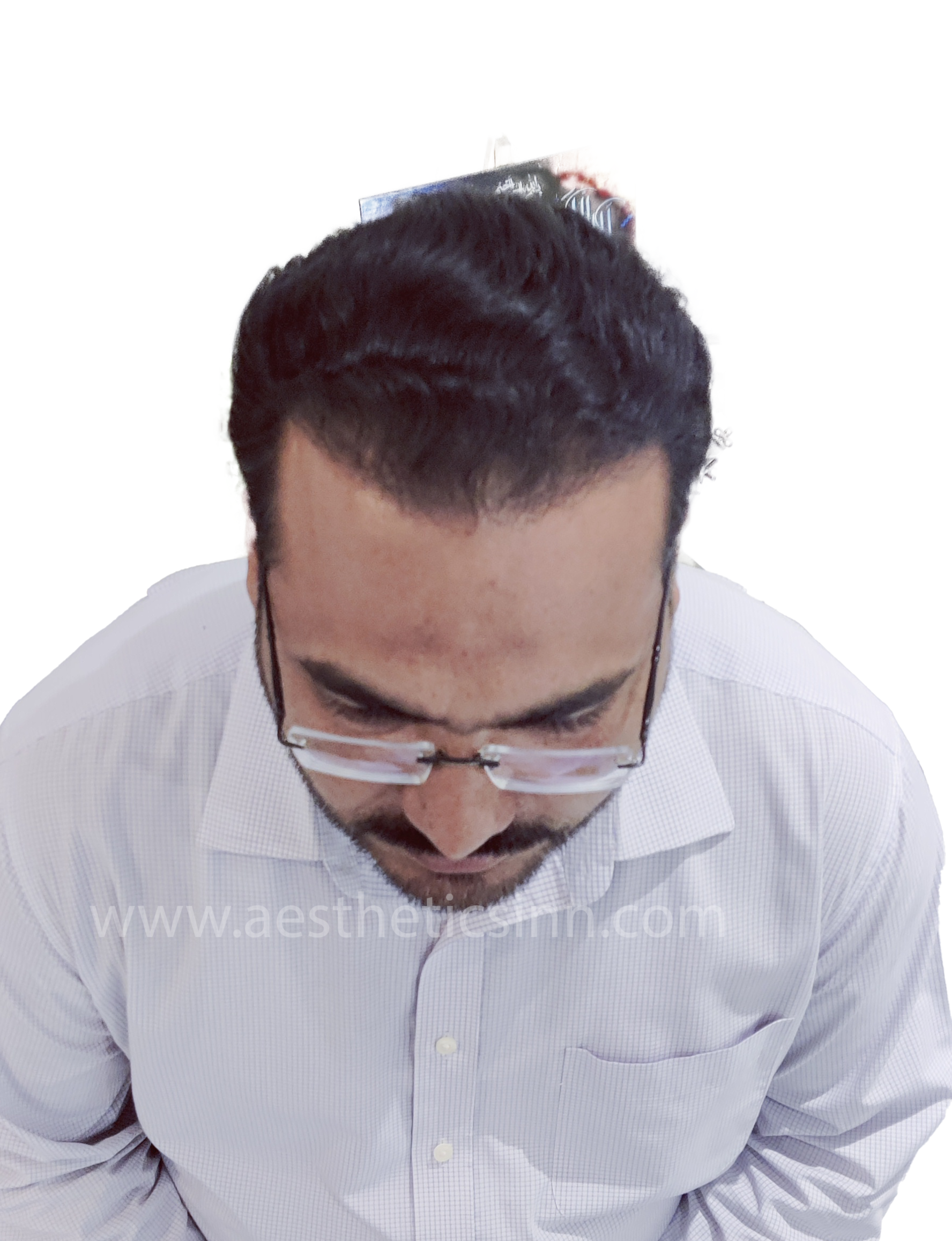 Riaz Butt Mid-Scalp After
