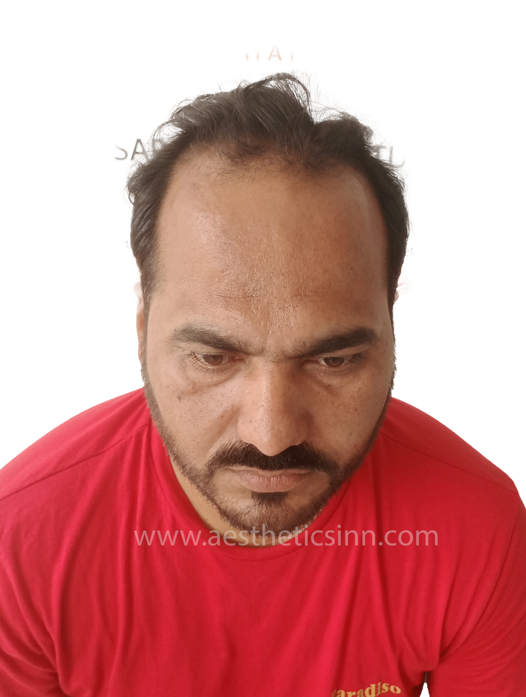 Before Hair Transplant - Riaz Butt
