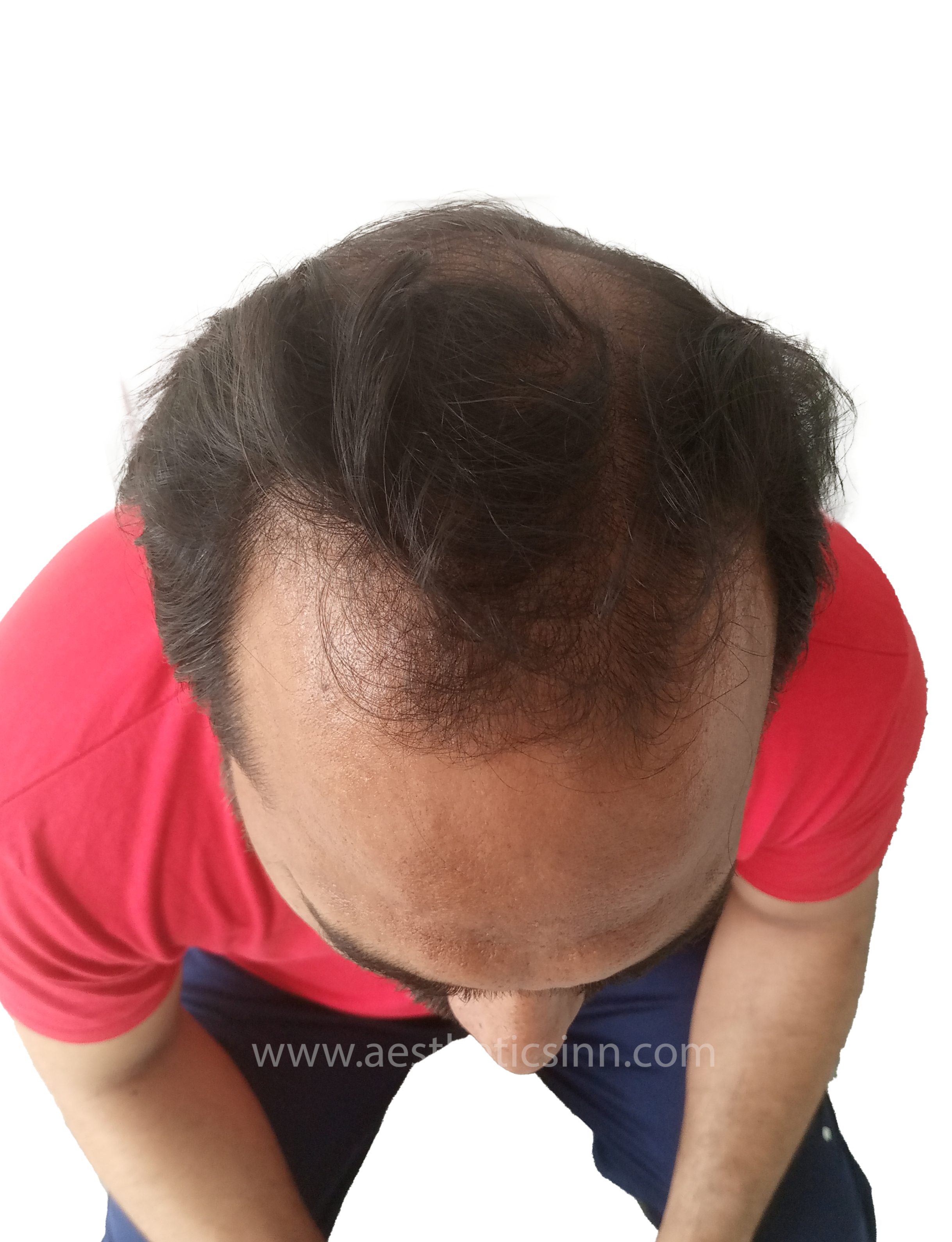 Riaz Butt Mid-Scalp Before