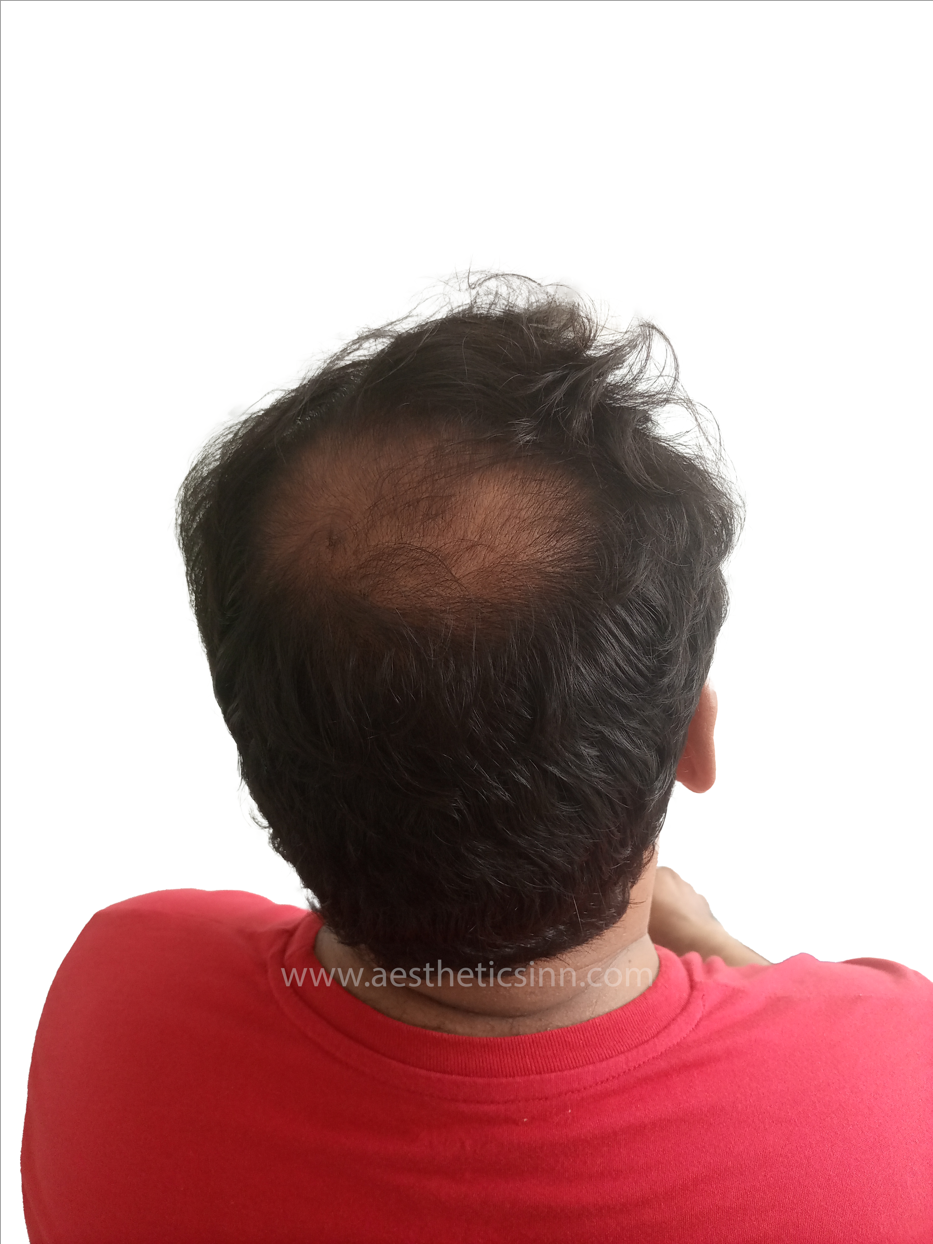 Riaz Butt Pre-Op Hairline Design