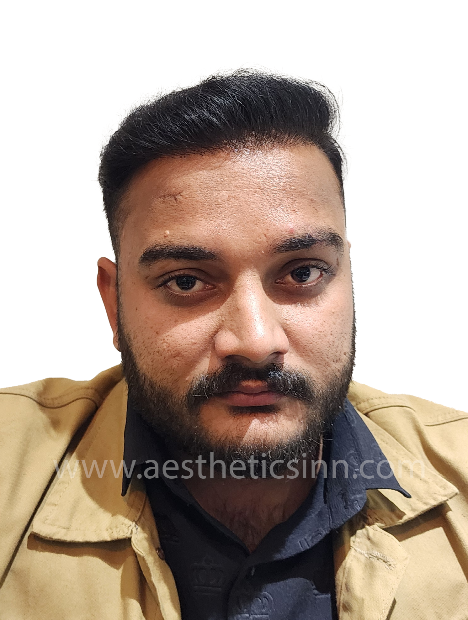 After Hair Transplant - Shahryar Liaqat