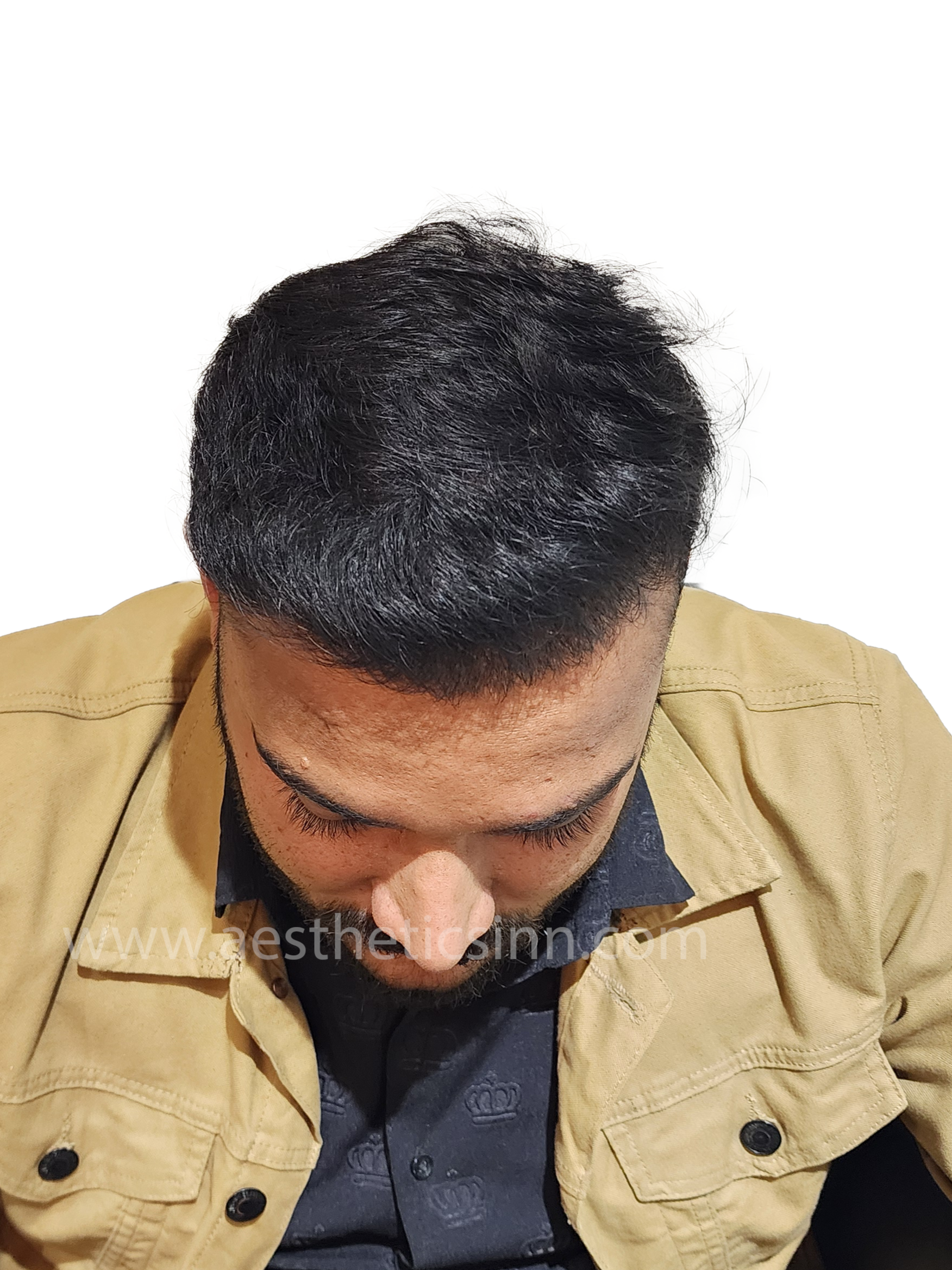 Shahryar Liaqat Mid-Scalp After