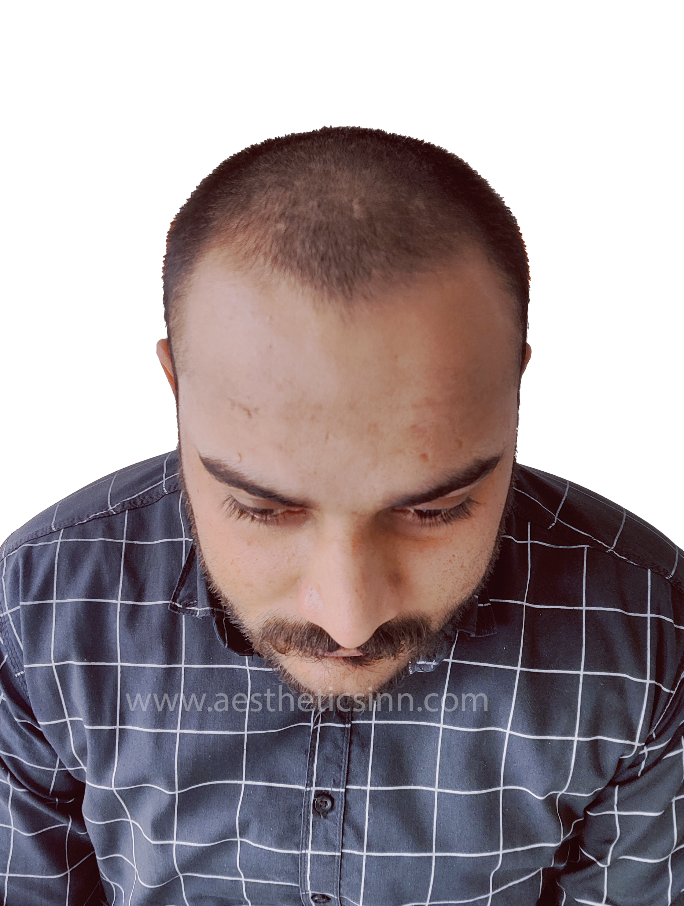 Before Hair Transplant - Shahryar Liaqat