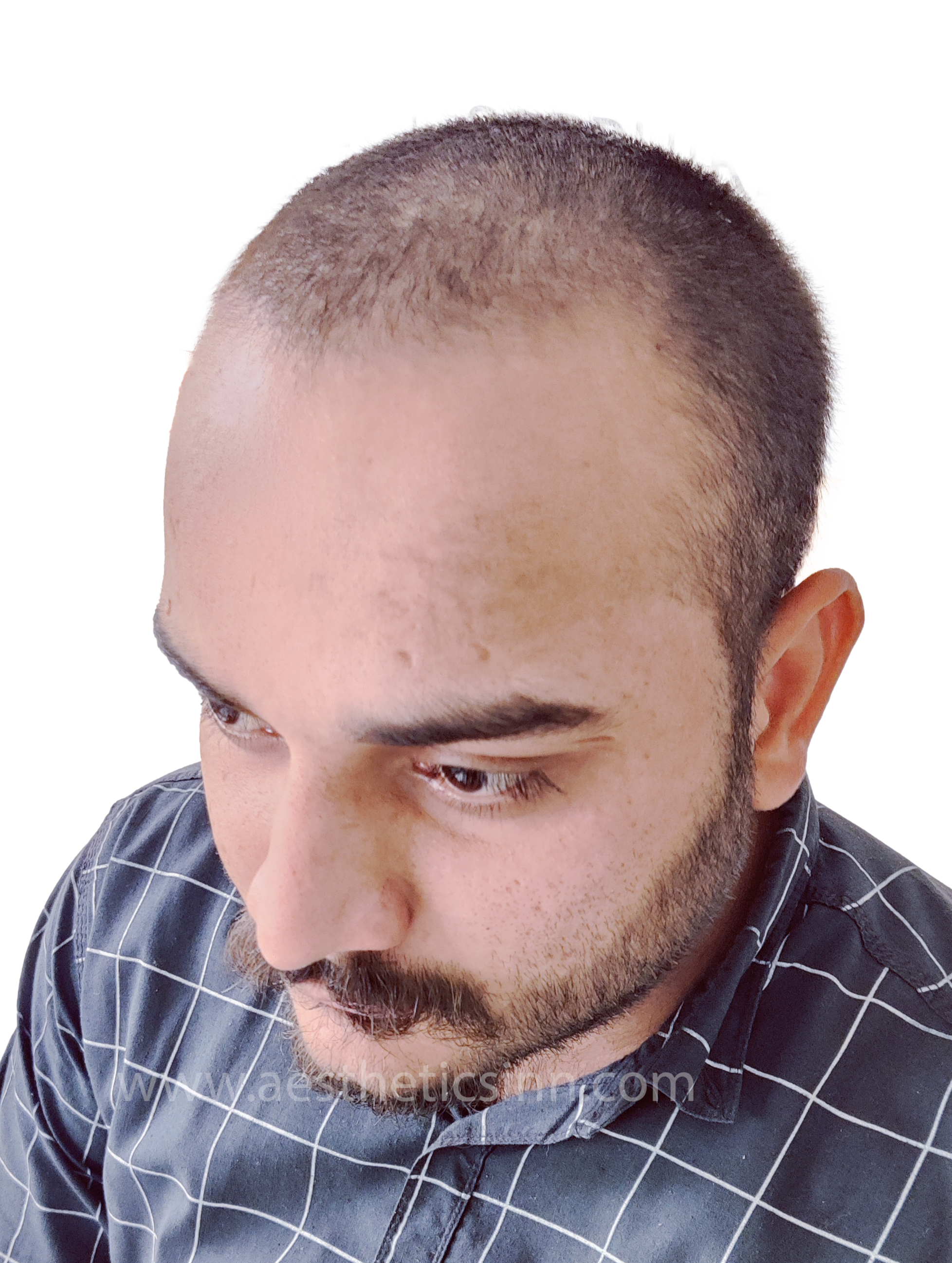 Shahryar Liaqat Right Profile Before