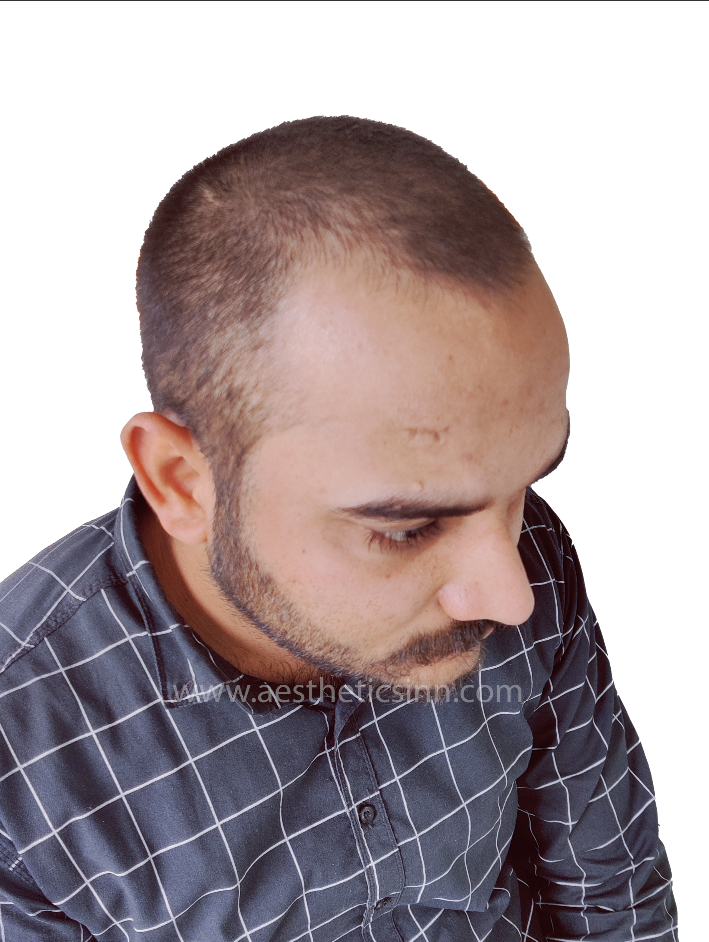 Shahryar Liaqat Left Profile Before