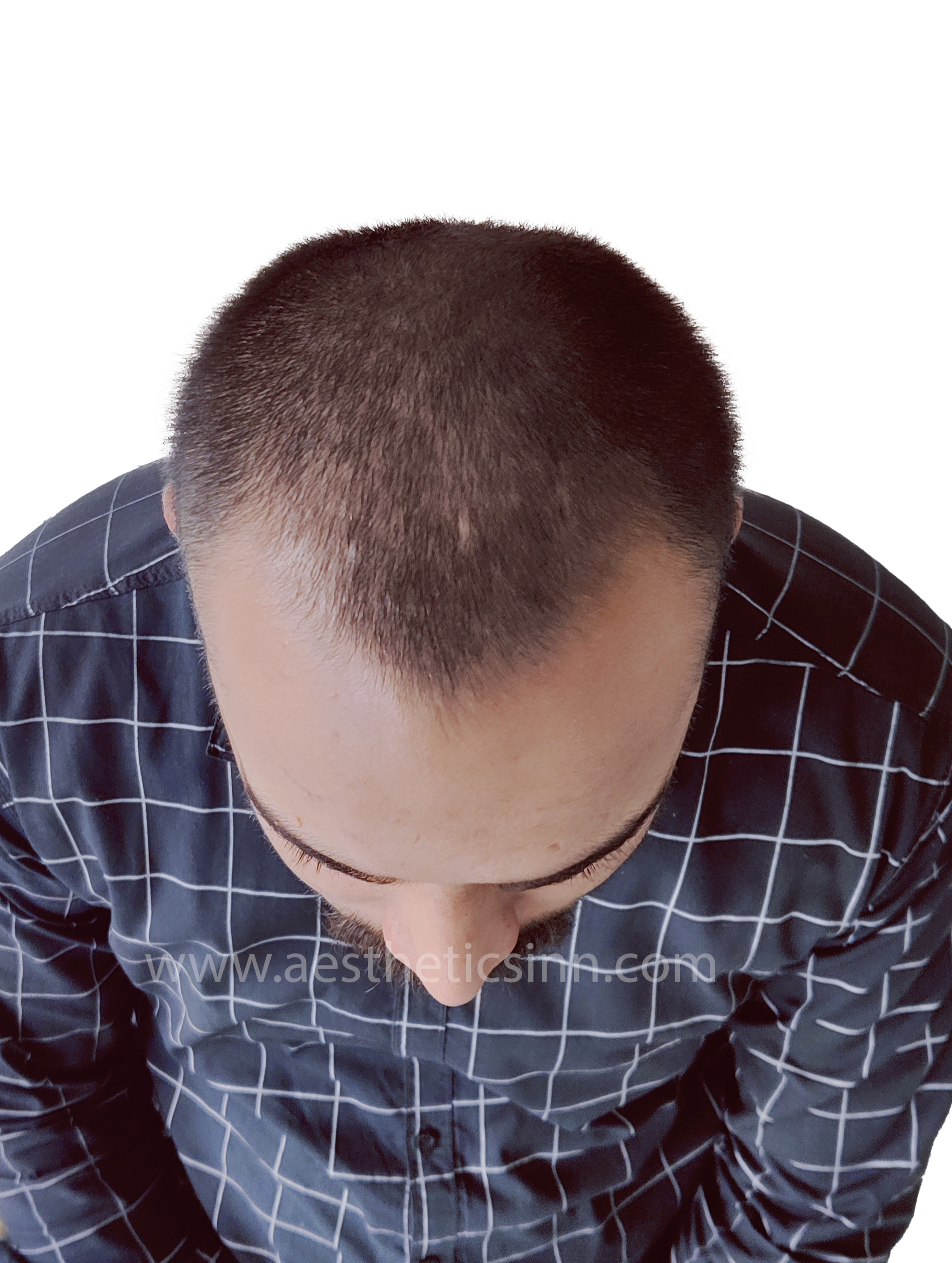 Shahryar Liaqat Mid-Scalp Before