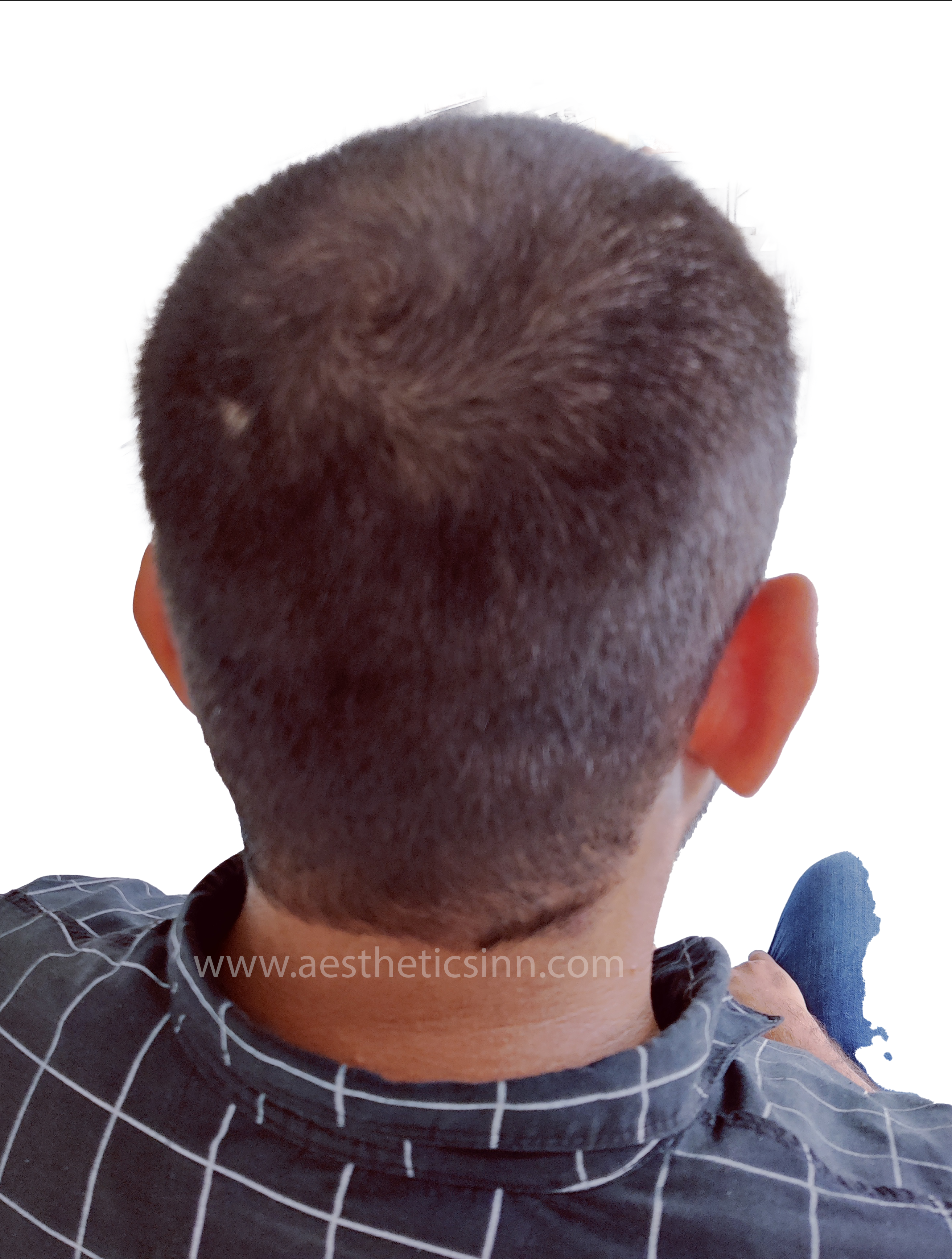 Shahryar Liaqat Pre-Op Hairline Design