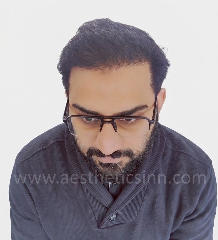 After Hair Transplant - Afan Mushtaq