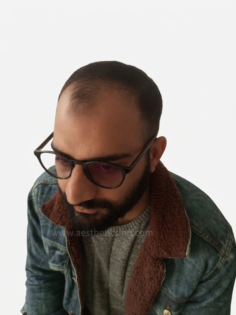 Afan Mushtaq Frontal Left Before