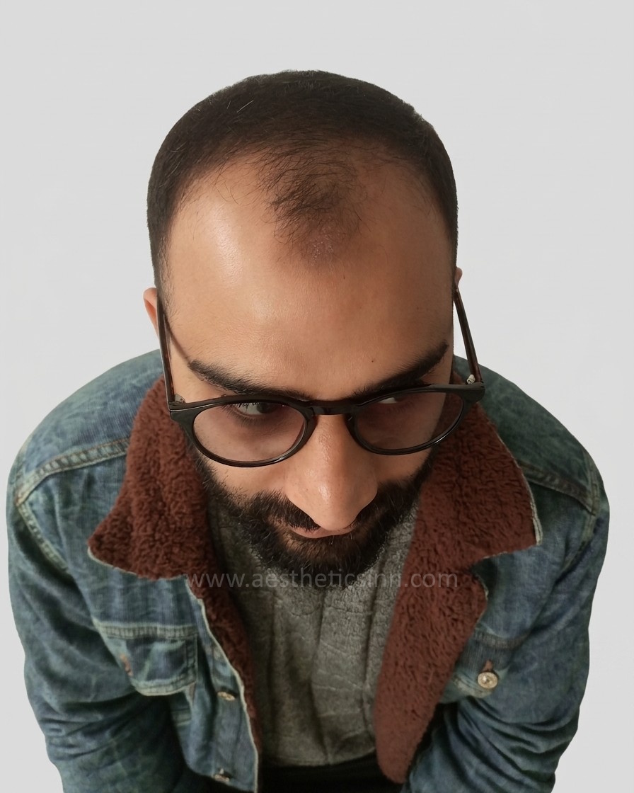 Before Hair Transplant - Afan Mushtaq