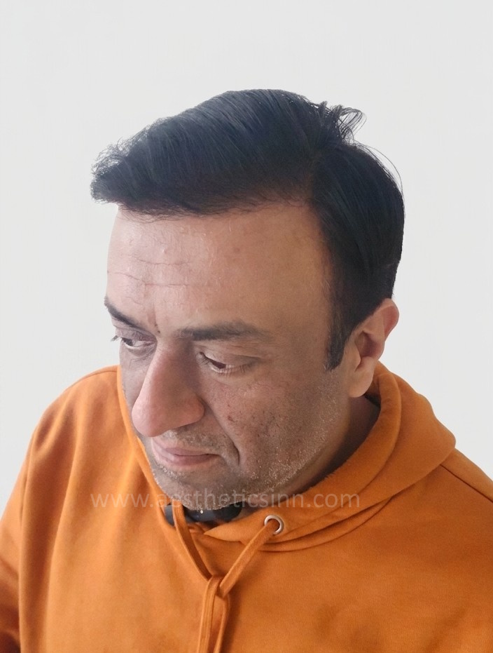Faisal Adrees Right Temple After