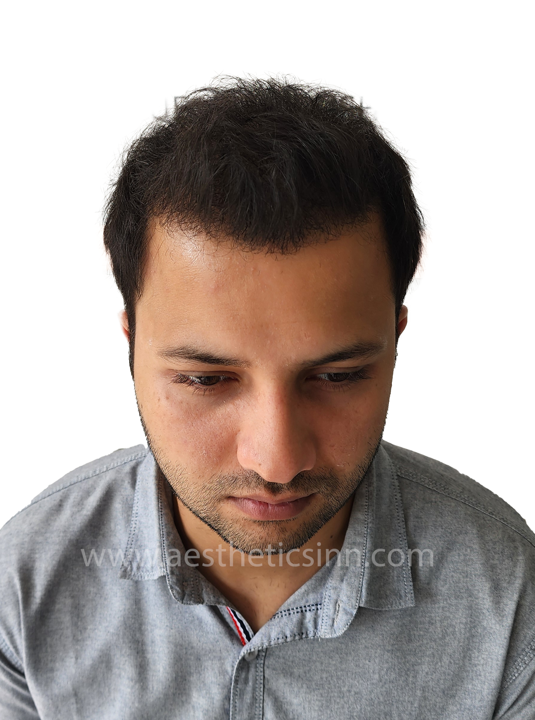 After Hair Transplant - Hamza Kahloon