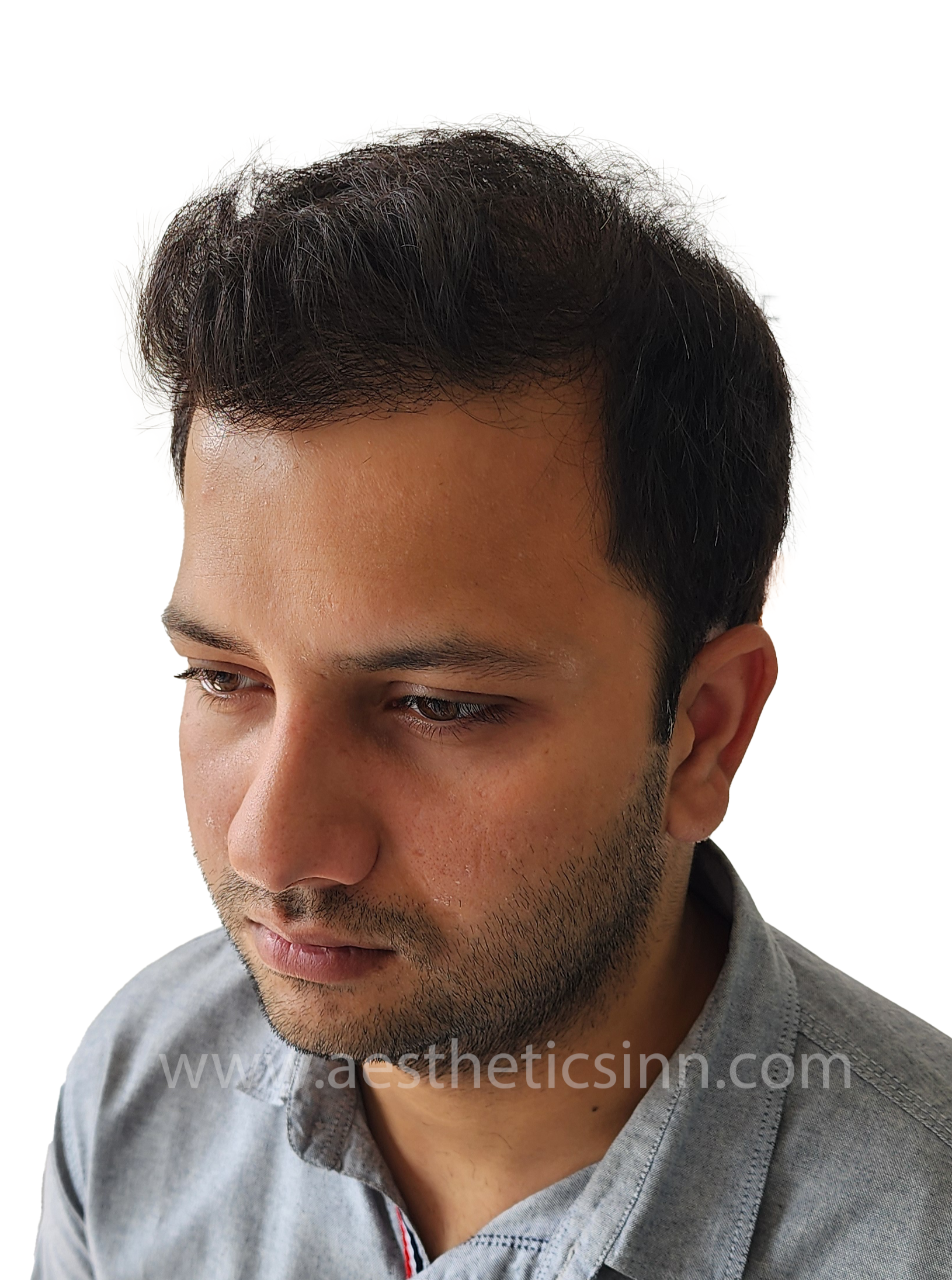 Hamza Kahloon Right Profile After