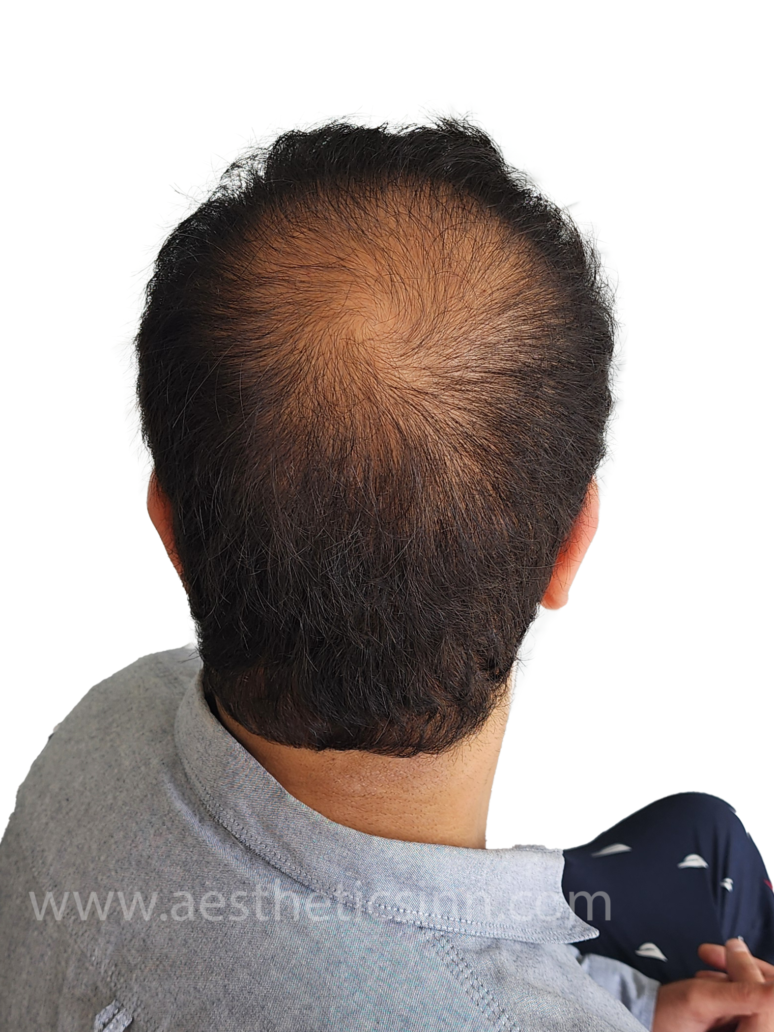 Hamza Kahloon Posterior Crown After